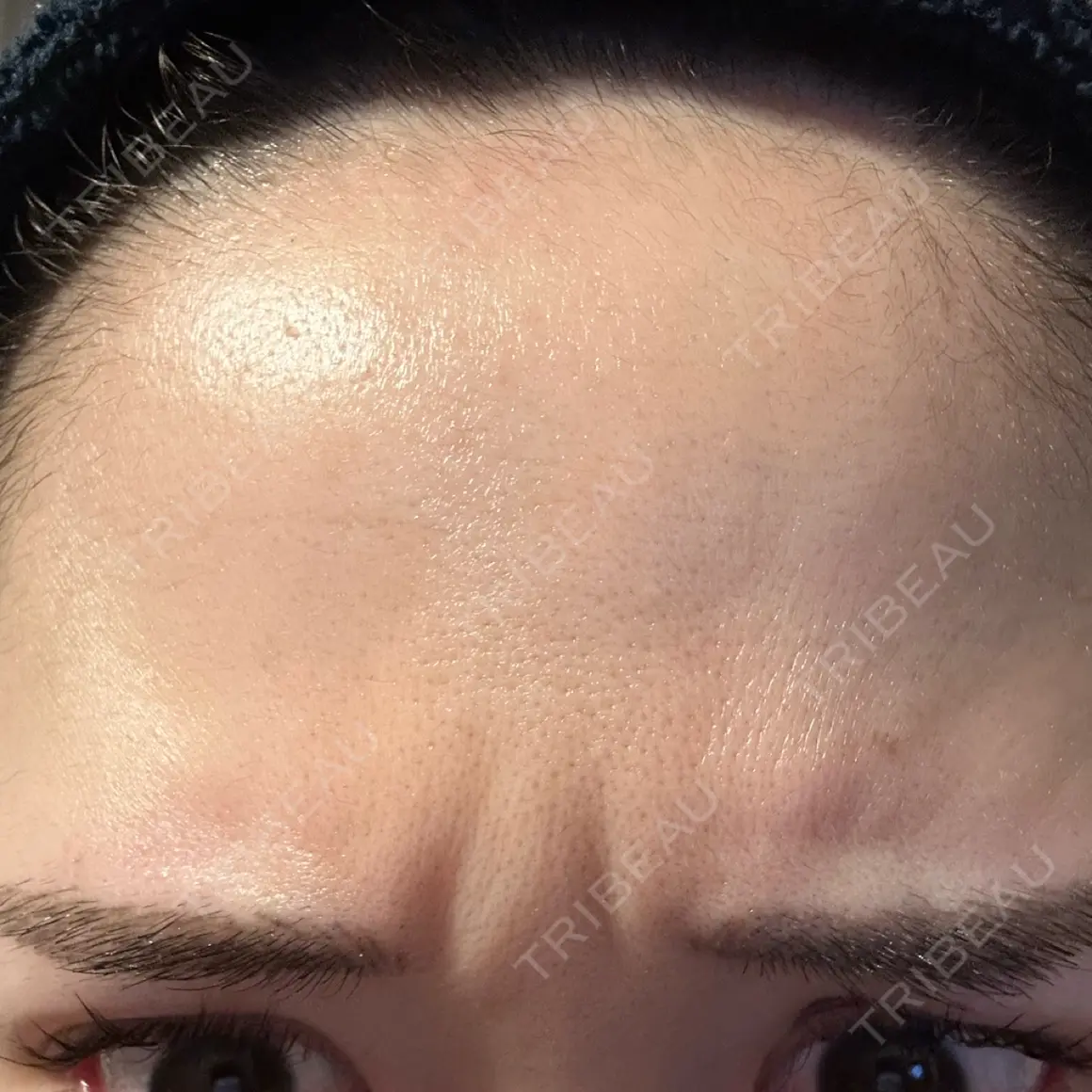 シワ取りボトックス / ボトックス（眉間） / ボトックス（額） Zetith Beauty Clinic 福岡院 DAY 0