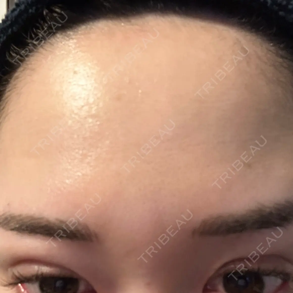 シワ取りボトックス / ボトックス（眉間） / ボトックス（額） Zetith Beauty Clinic 福岡院 AFTER