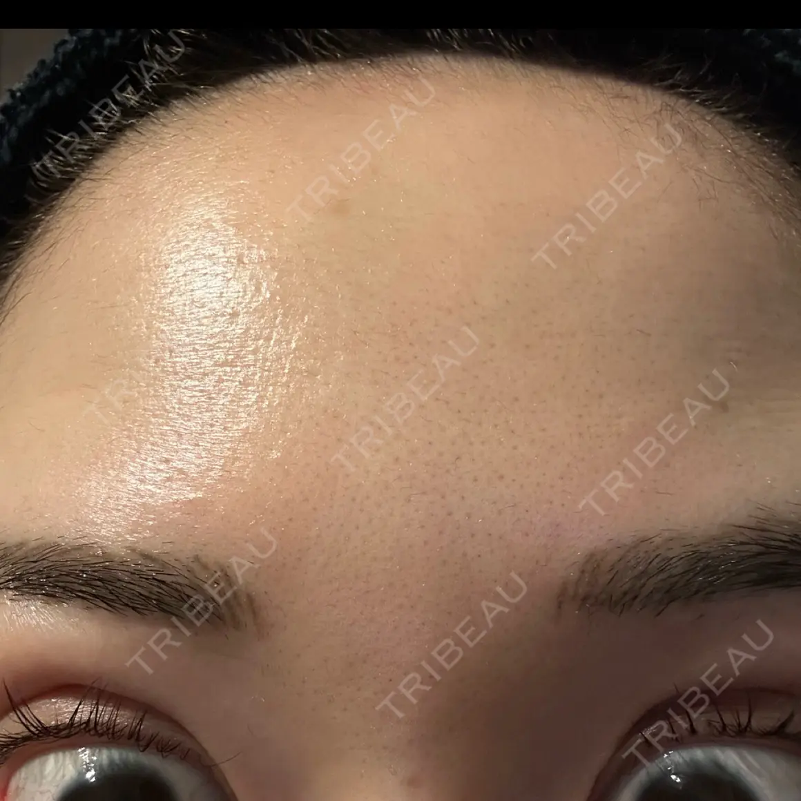 シワ取りボトックス / ボトックス（眉間） / ボトックス（額） Zetith Beauty Clinic 福岡院 AFTER