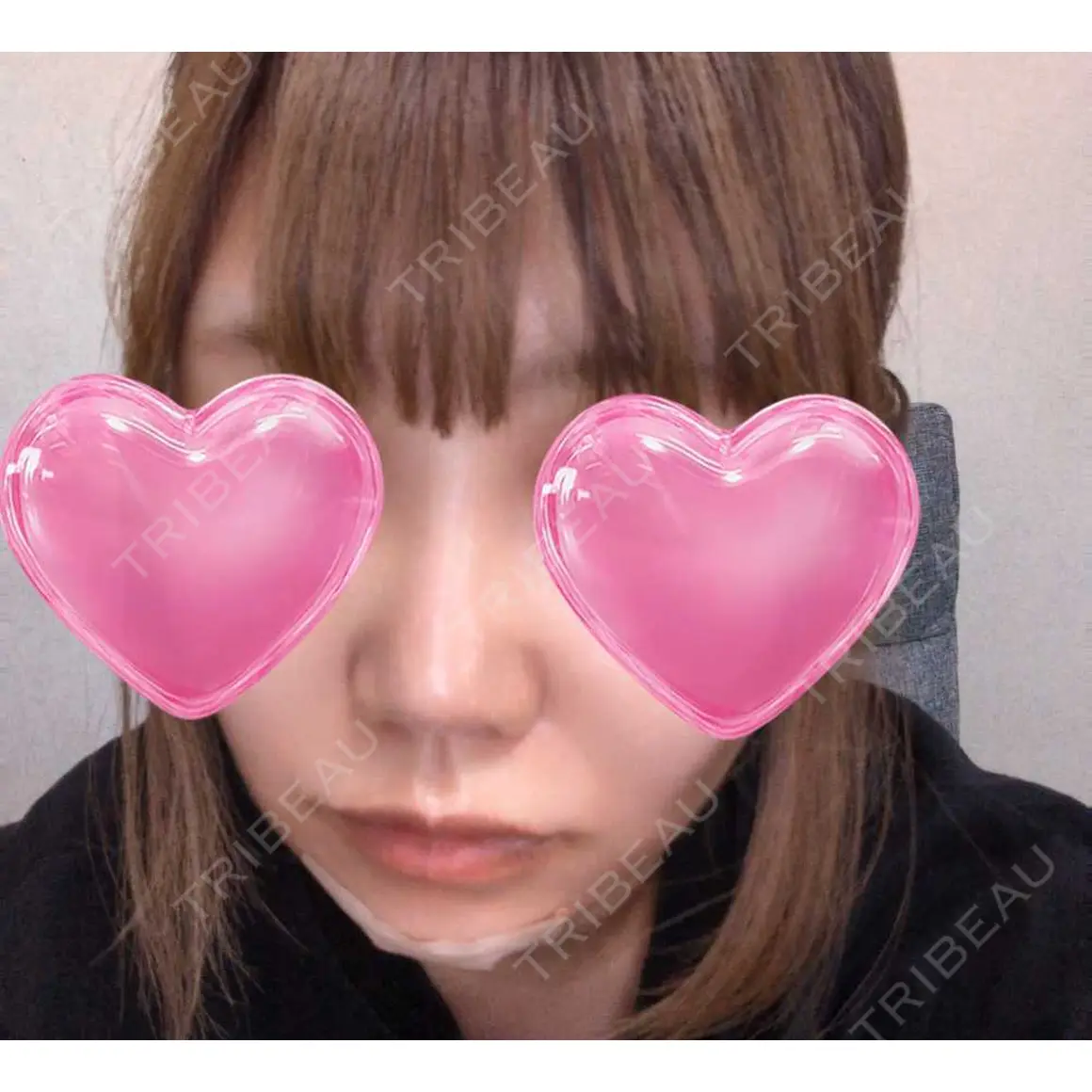 ヒアルロン酸注入（鼻） / ヒアルロン酸注入（あご） HAAB×DREAM BEAUTY CLINIC 東京本院 DAY 0