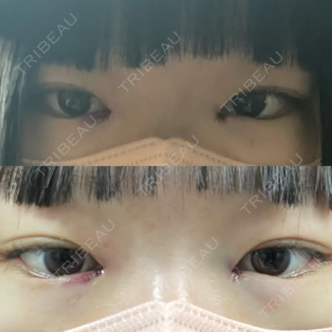 目頭切開 9BeautyClinic DAY 0