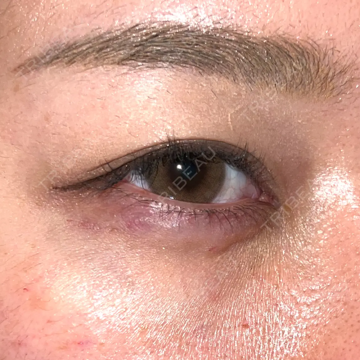 ヒアルロン酸注入（涙袋） oneUPclinic DAY 0