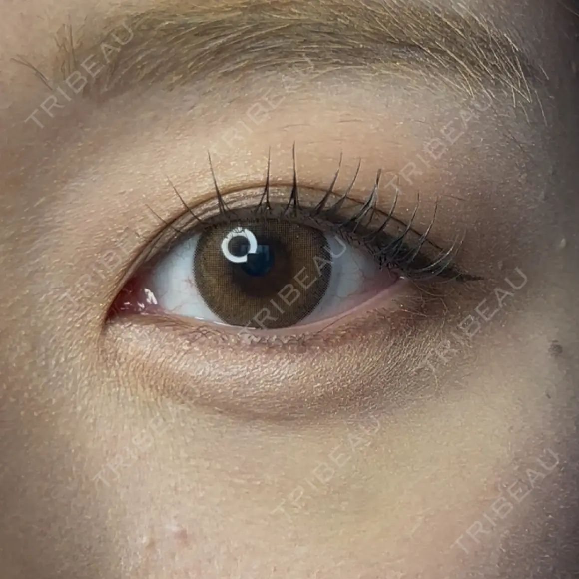 ヒアルロン酸注入（涙袋） oneUPclinic AFTER