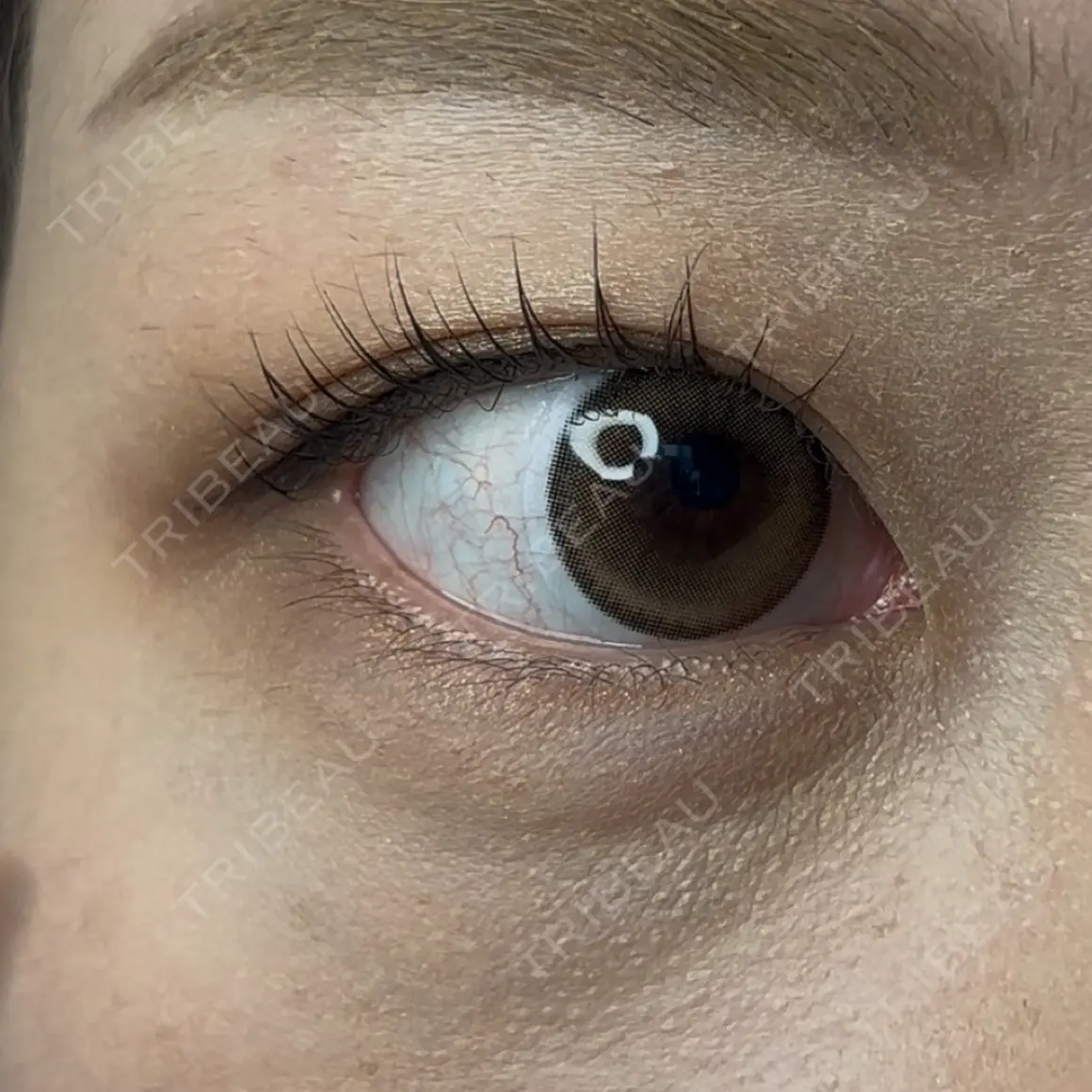 ヒアルロン酸注入（涙袋） oneUPclinic AFTER