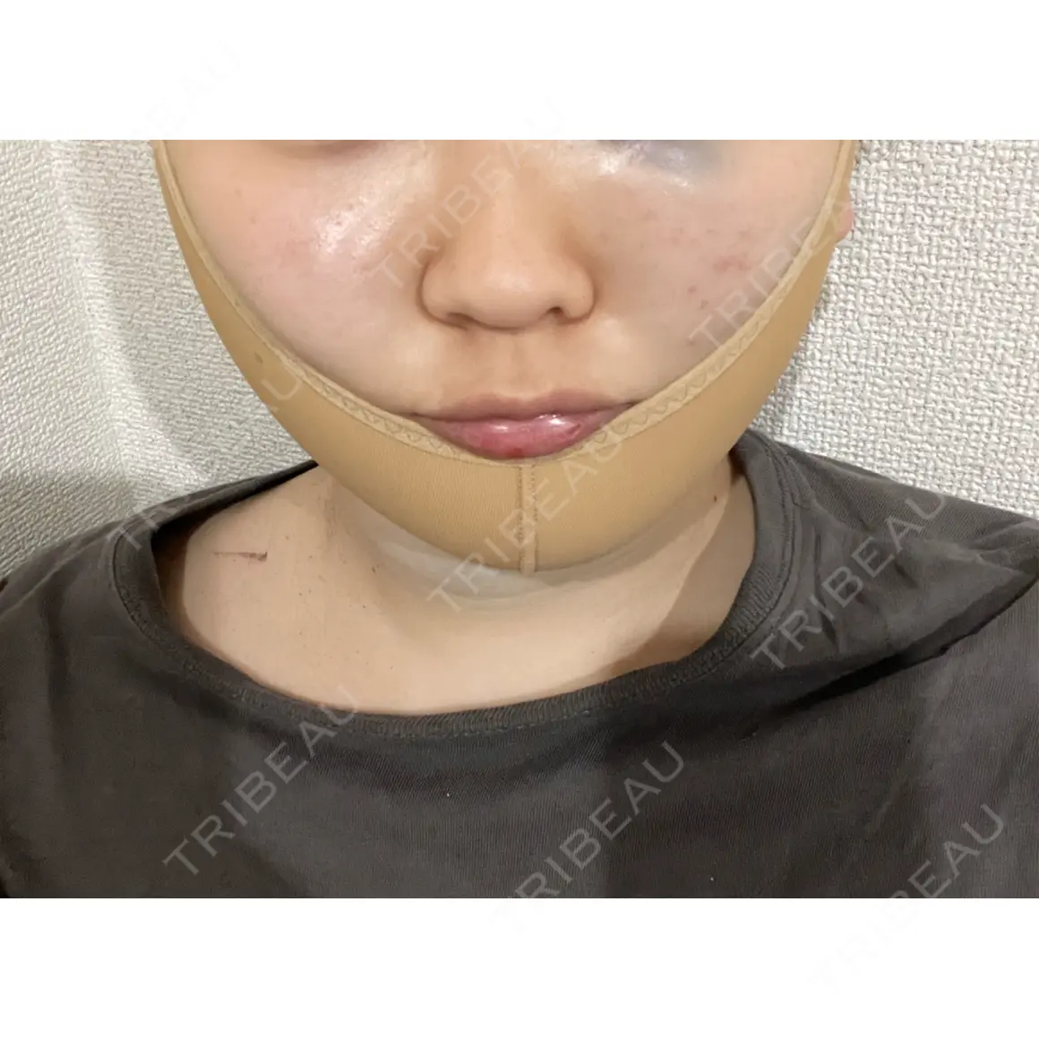 糸リフト / 脂肪吸引（顔） / ボトックス（あご） / その他（輪郭） ziz CLINIC DAY 0