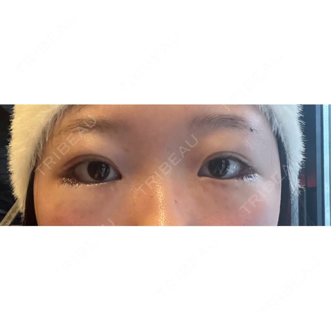 目尻切開 / タレ目形成・グラマラスライン（切開） プロミス整形外科 DAY 0