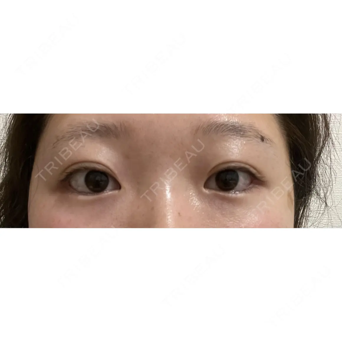 目尻切開 / タレ目形成・グラマラスライン（切開） プロミス整形外科 AFTER