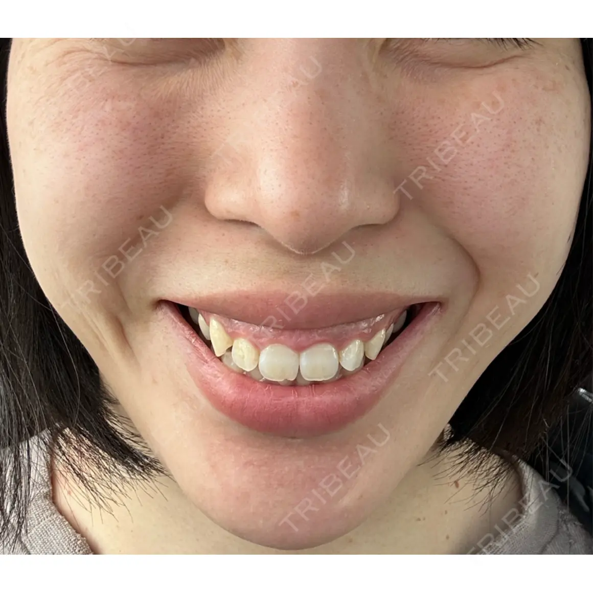 シワ取りボトックス / 医療脱毛（全身） Grias clinic （ジリアスクリニック） AFTER