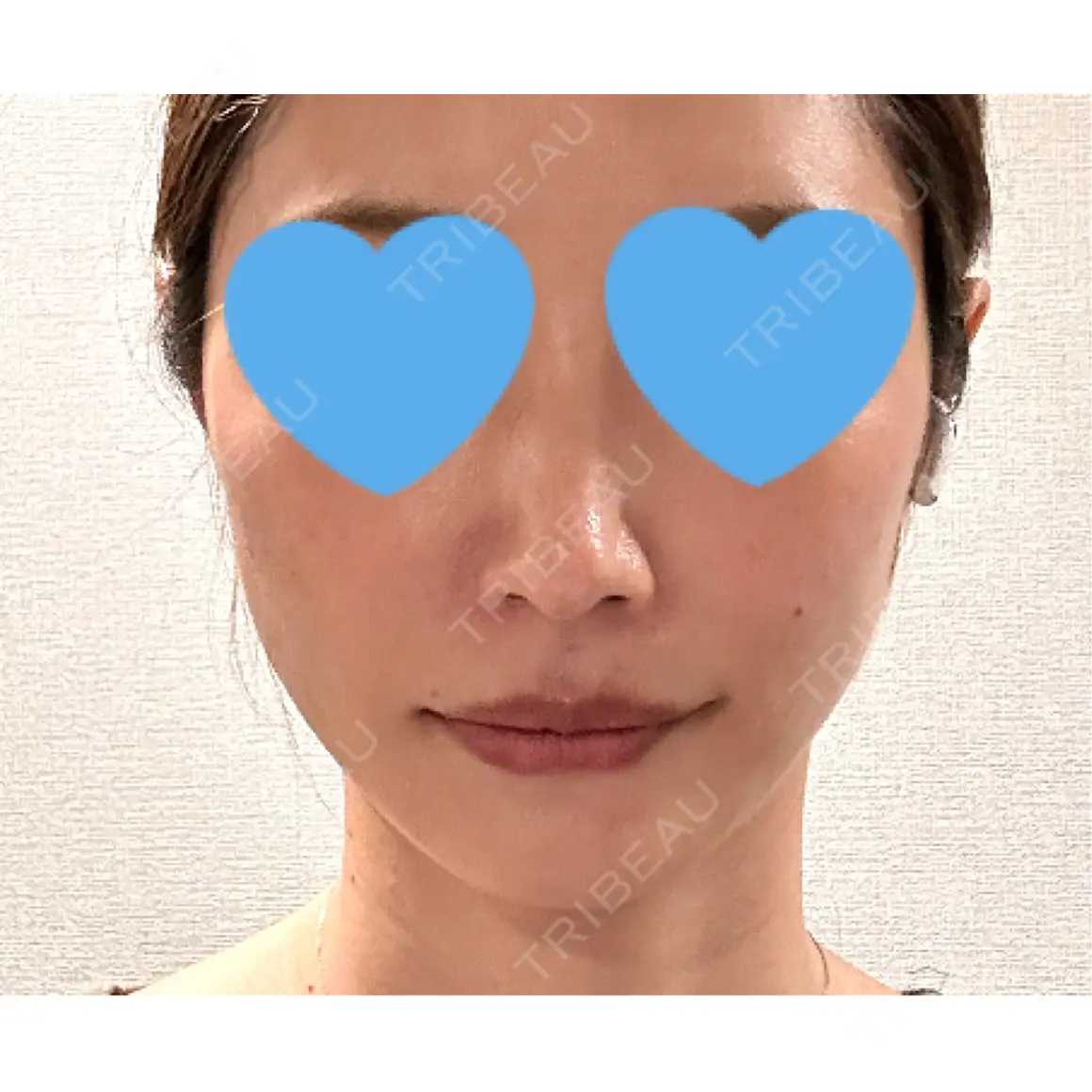 ヒアルロン酸注入（頬） ルラ美容クリニック 東京駅前院 DAY 0