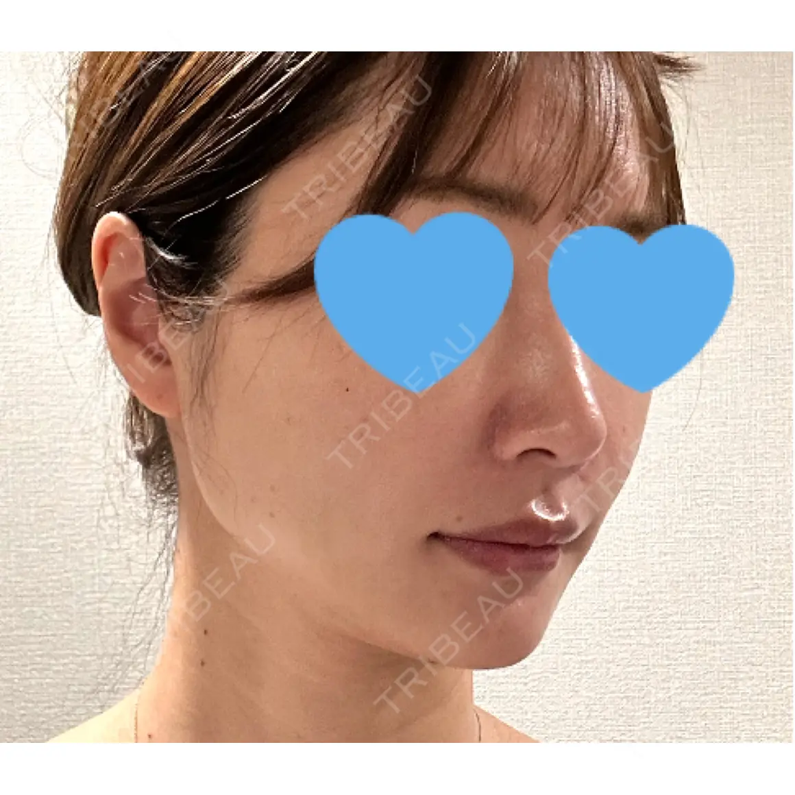 ヒアルロン酸注入（頬） ルラ美容クリニック 東京駅前院 AFTER