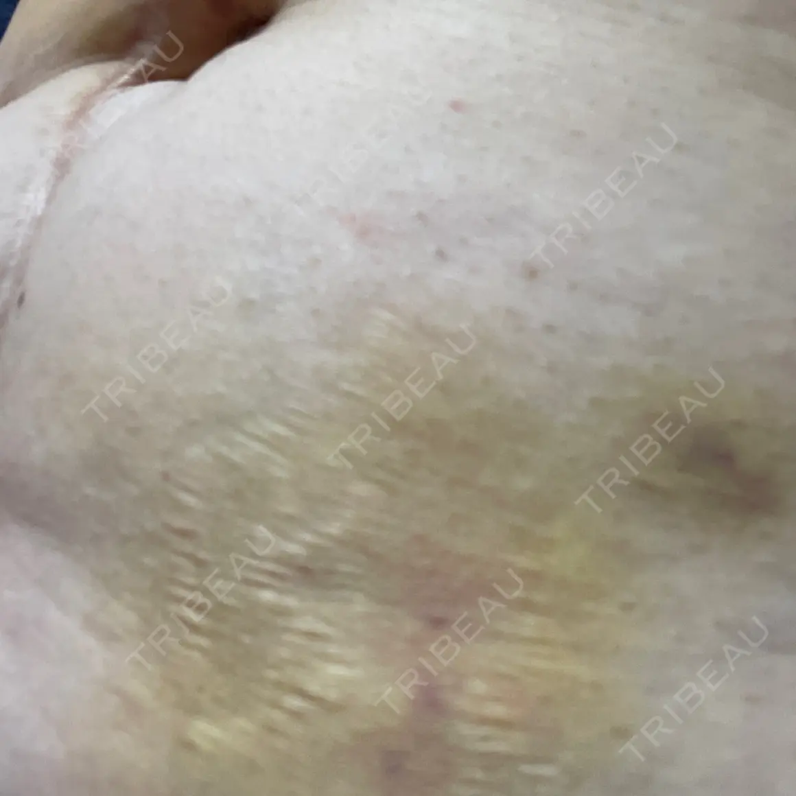 脂肪溶解注射 CLINIC W AFTER