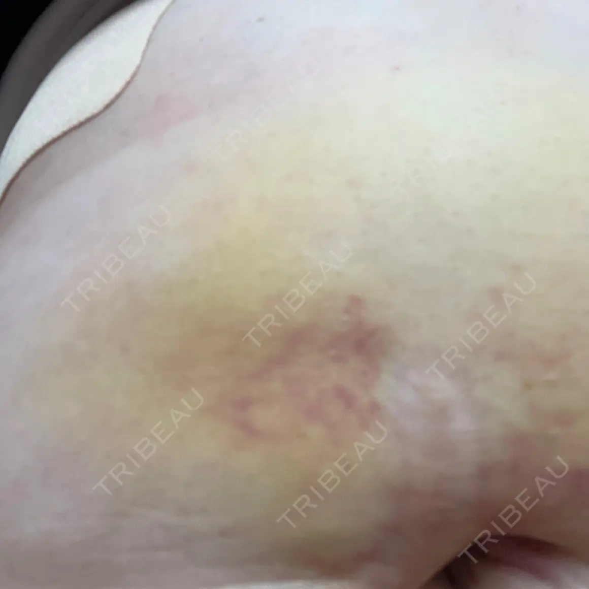 脂肪溶解注射 CLINIC W AFTER