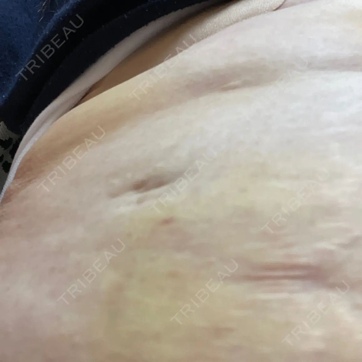脂肪溶解注射 CLINIC W AFTER