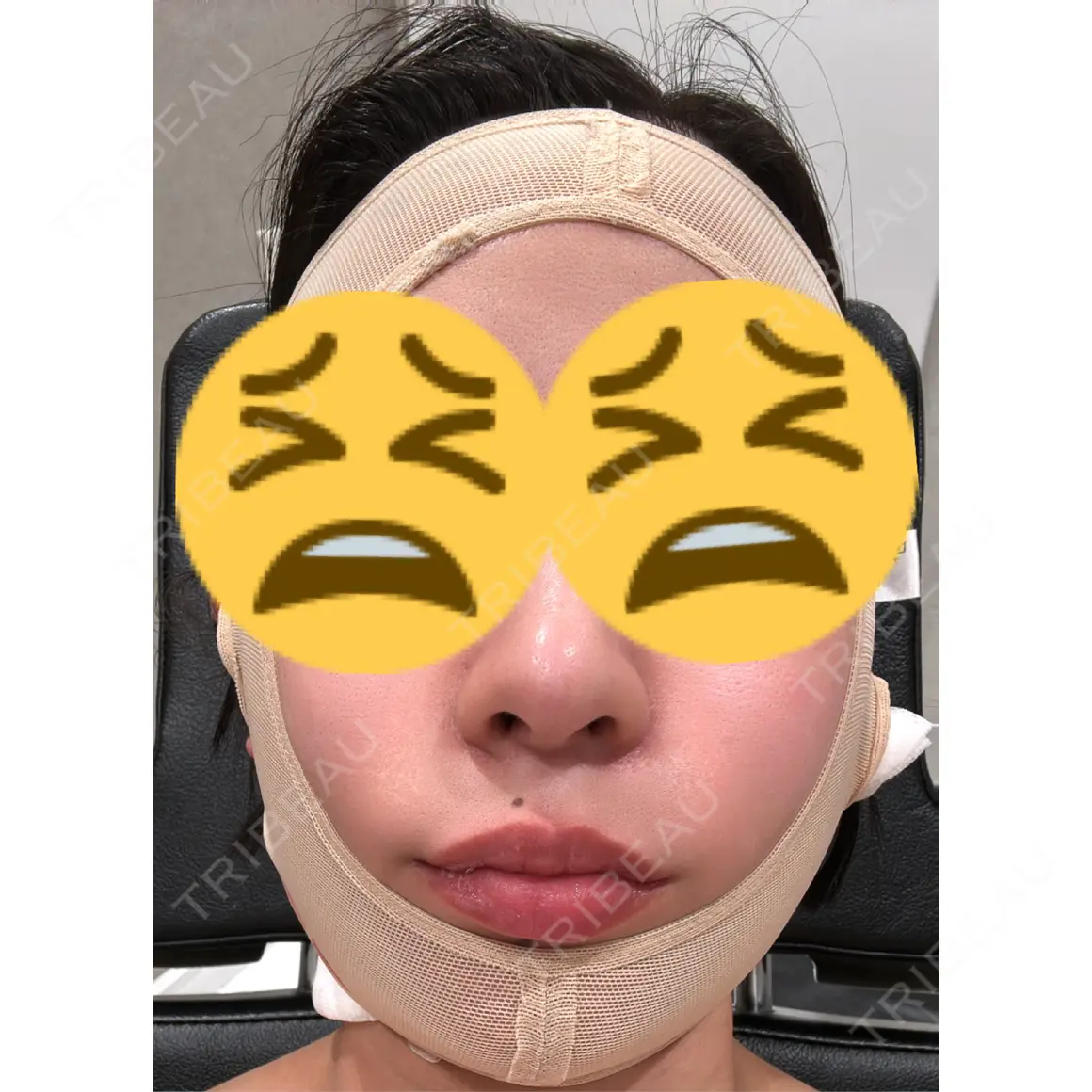糸リフト / 脂肪吸引（顔） Shion Beauty Clinic DAY 0