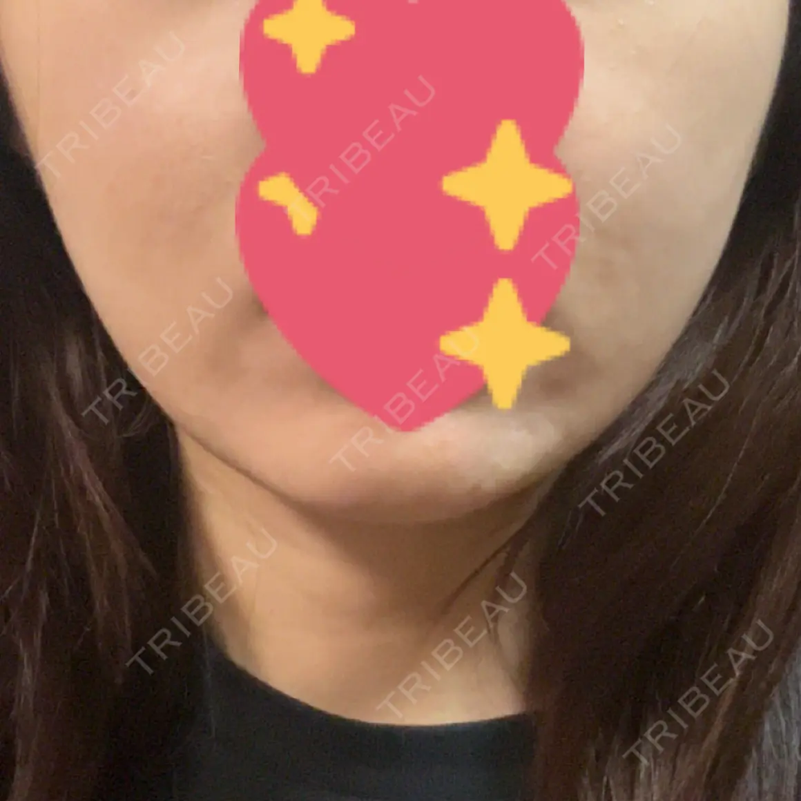 ボトックス（エラ・小顔） WellnessPlus Clinic 【ウェルネスプラスクリニック】 AFTER
