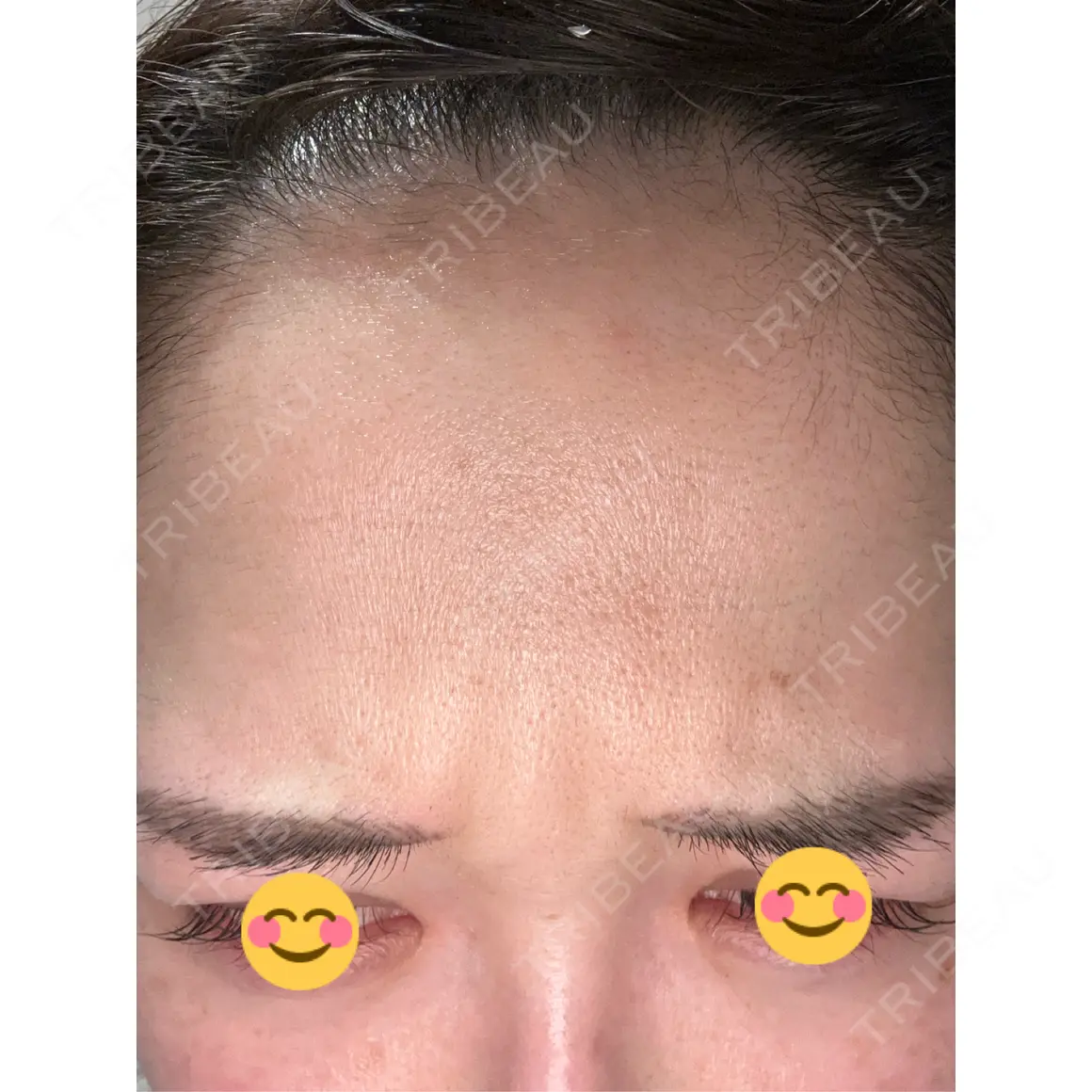 シワ取りボトックス / ボトックス（眉間） / ボトックス（額） Zetith Beauty Clinic 福岡院 AFTER