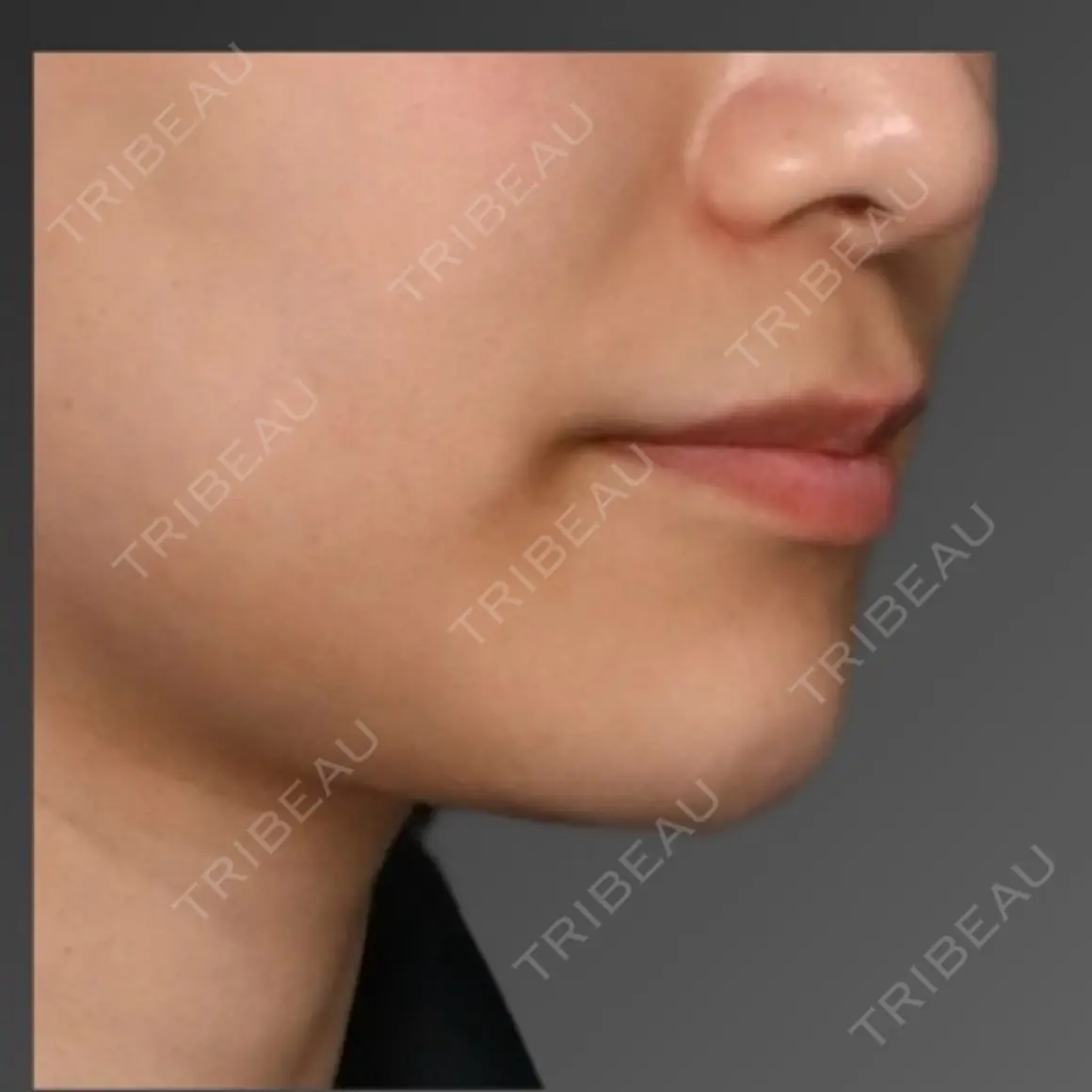脂肪注入（輪郭） Lipo Clinic omotesando AFTER