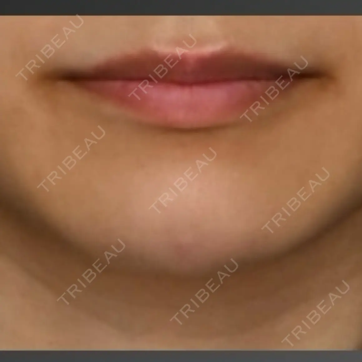 脂肪注入（輪郭） Lipo Clinic omotesando AFTER