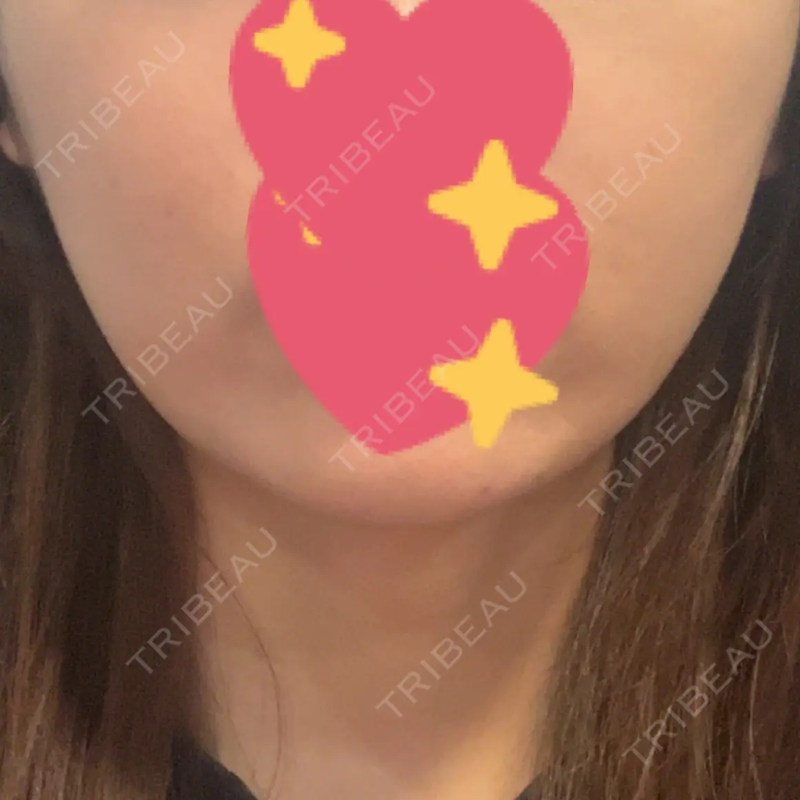 ボトックス（エラ・小顔） WellnessPlus Clinic 【ウェルネスプラスクリニック】 AFTER