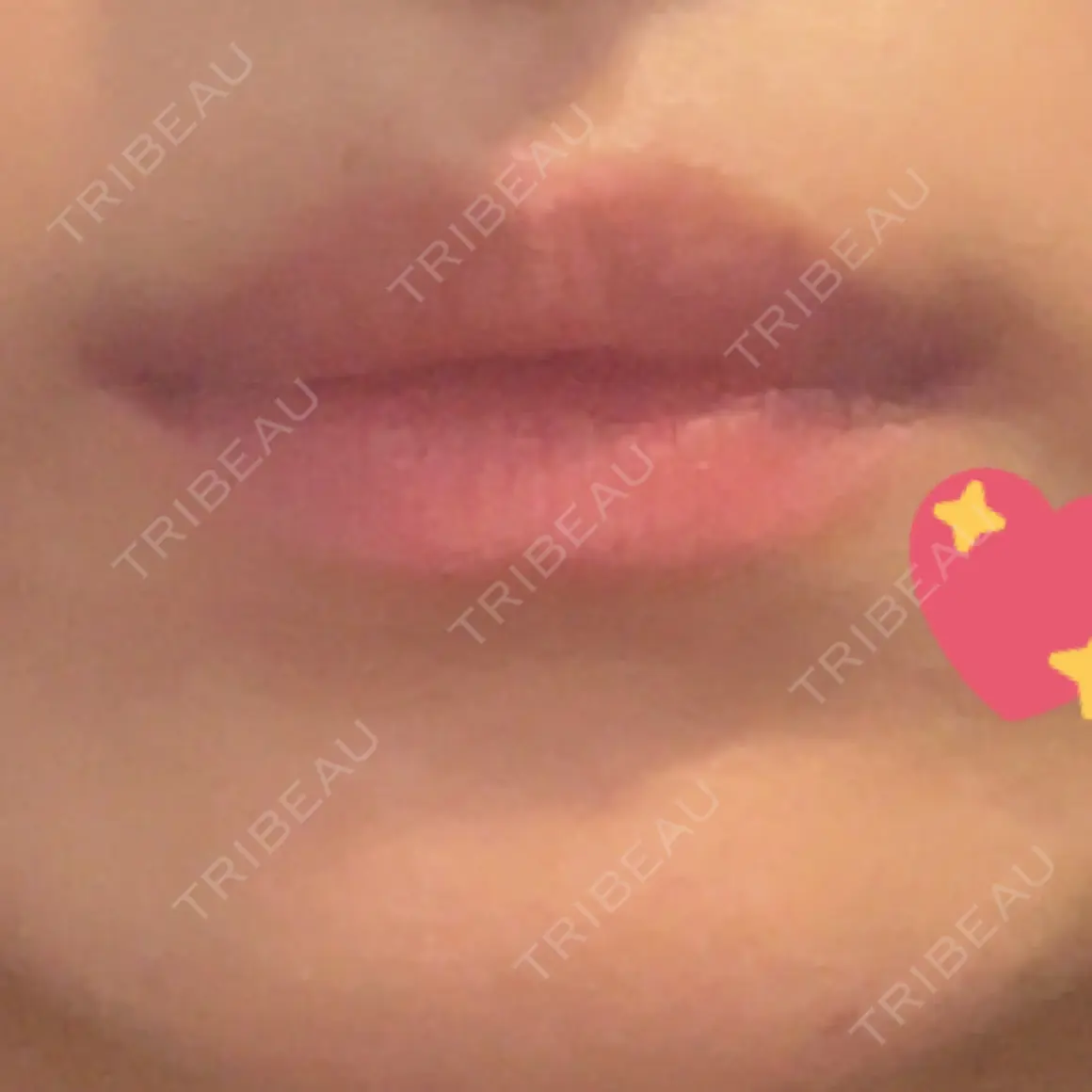 ボトックス（口角） WellnessPlus Clinic 【ウェルネスプラスクリニック】 AFTER
