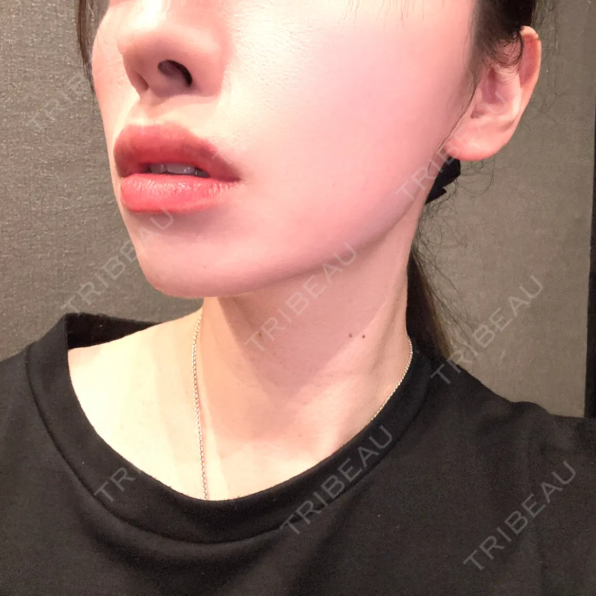 ヒアルロン酸注入（唇） PRO CLINIC プロクリニック 銀座院 DAY 1