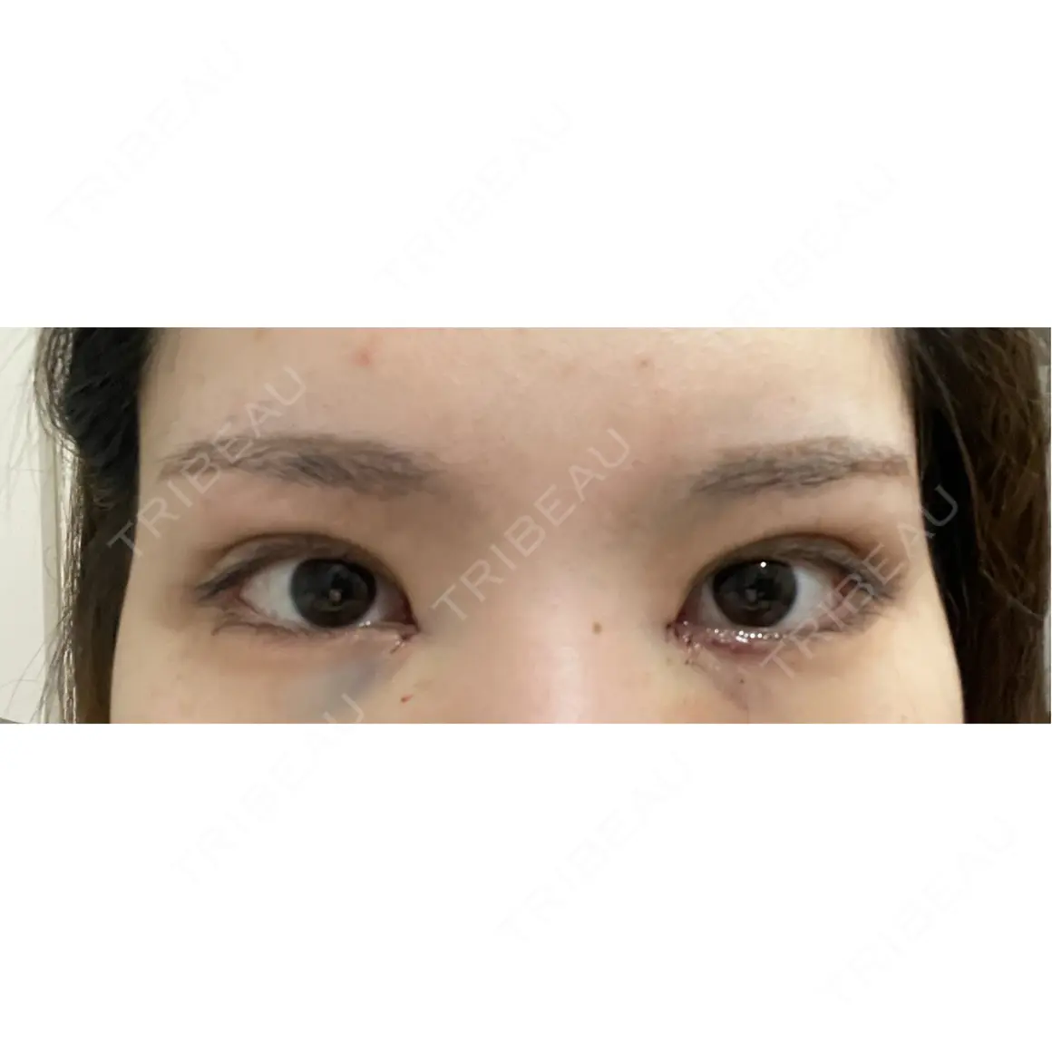 二重埋没 / 目頭切開 9BeautyClinic DAY 0