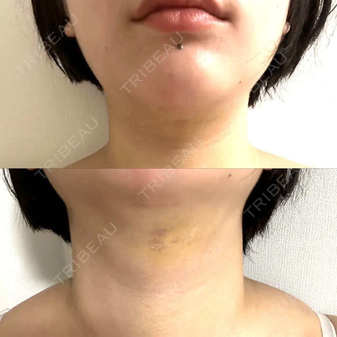 糸リフト / 脂肪吸引（顔） Shion Beauty Clinic AFTER