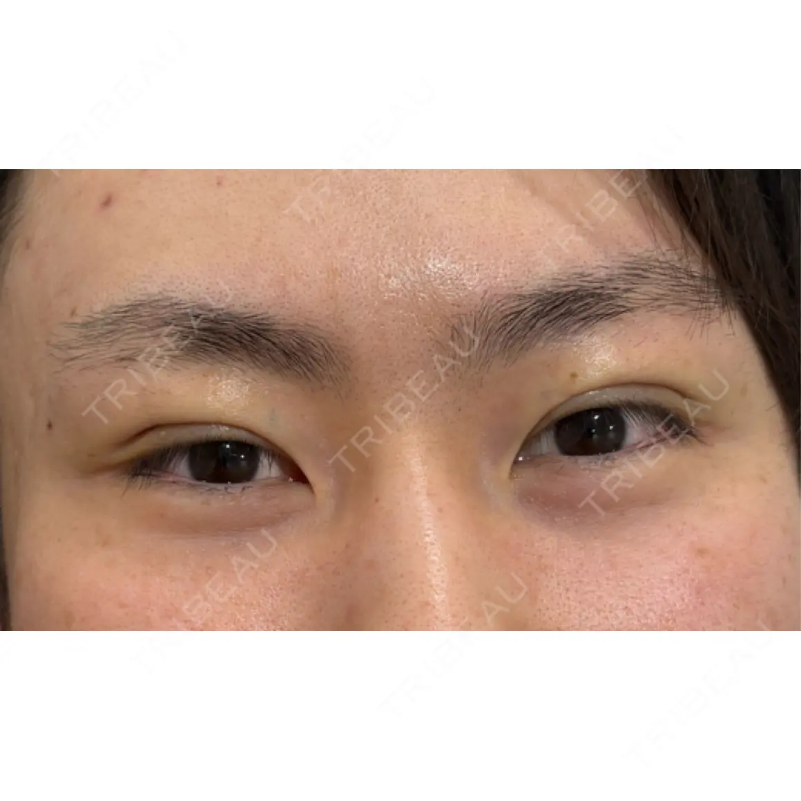 二重埋没 / 上まぶたの脂肪取り アリエル美容クリニック 横浜院 DAY 0