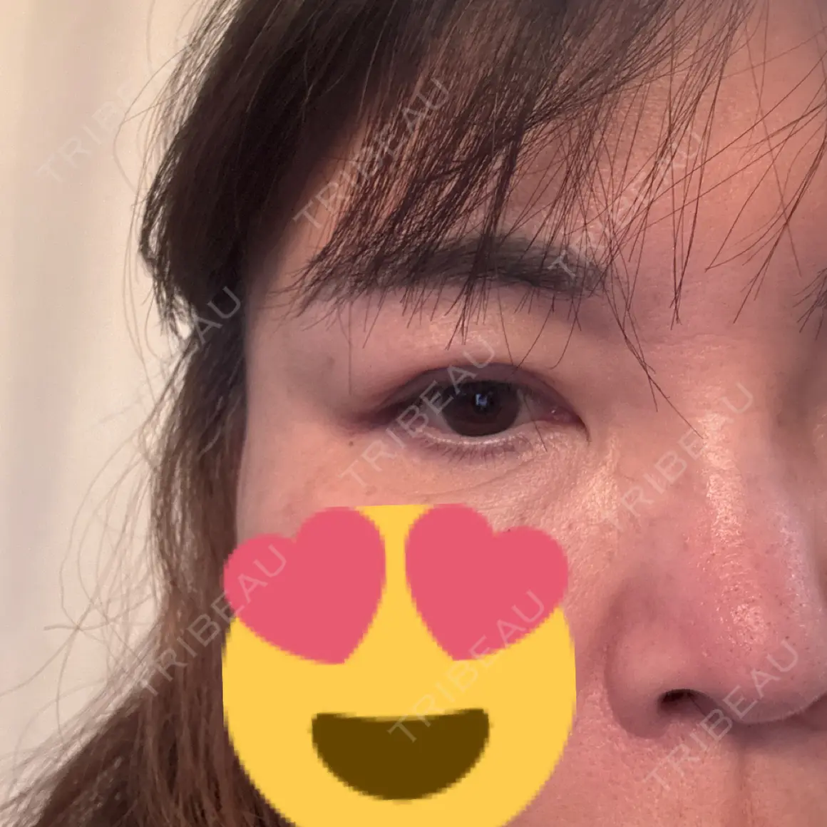 二重埋没 / 目元修正 BELINDA CLINIC（ベリンダクリニック）岡山院 AFTER