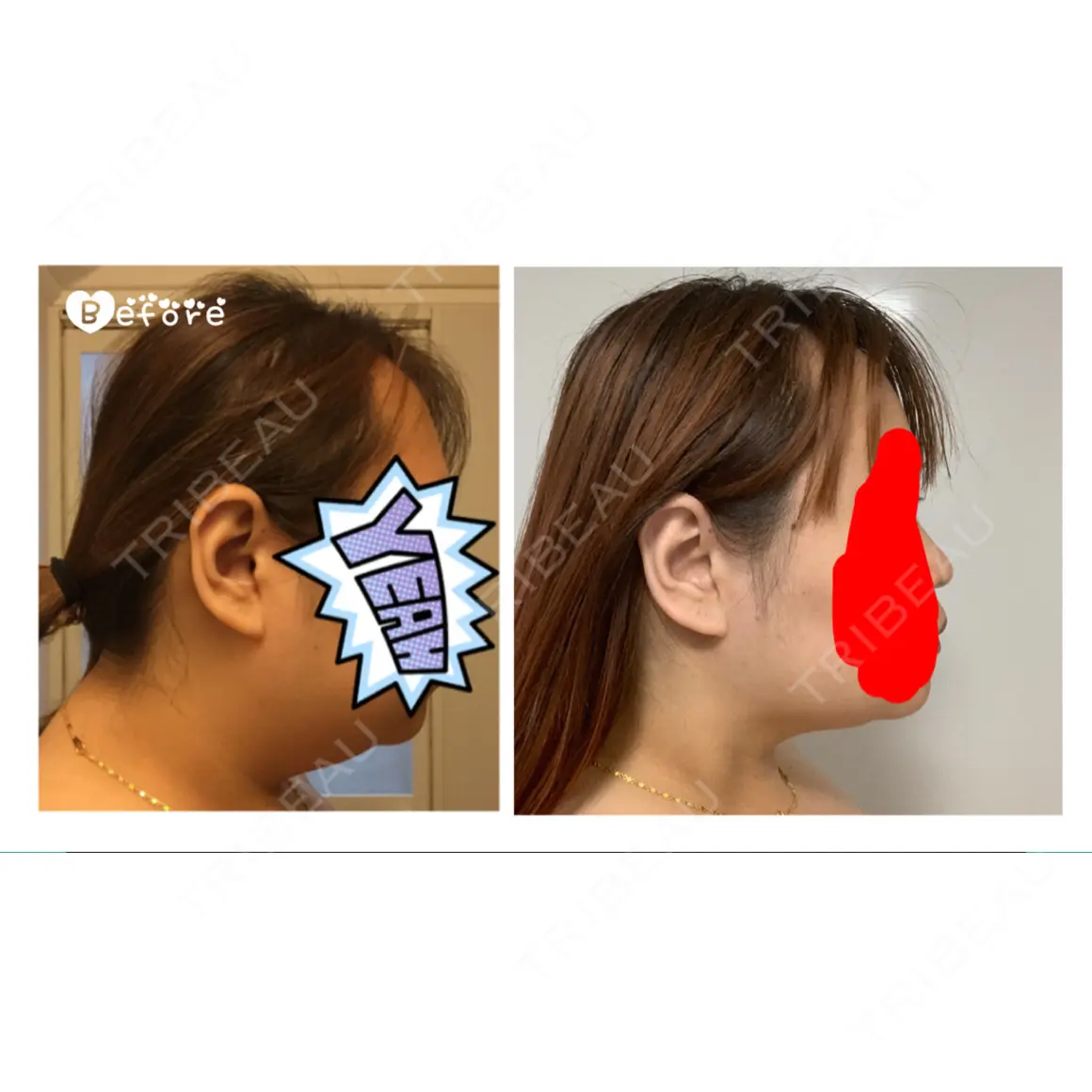 脂肪吸引（顔） アサミ美容外科 名古屋院 AFTER