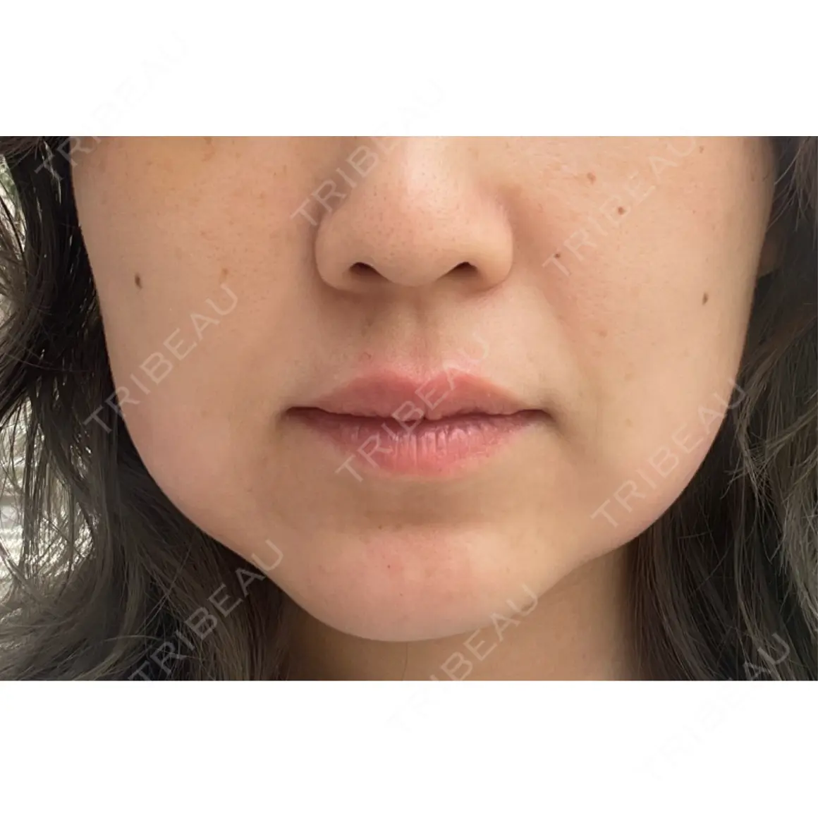 ボトックス（あご） / ボトックス（エラ・小顔） / 脂肪溶解注射（顔） / ボトックス（人中） Kinshicho Beauty Clinic （錦糸町ビューティークリニック） DAY 0