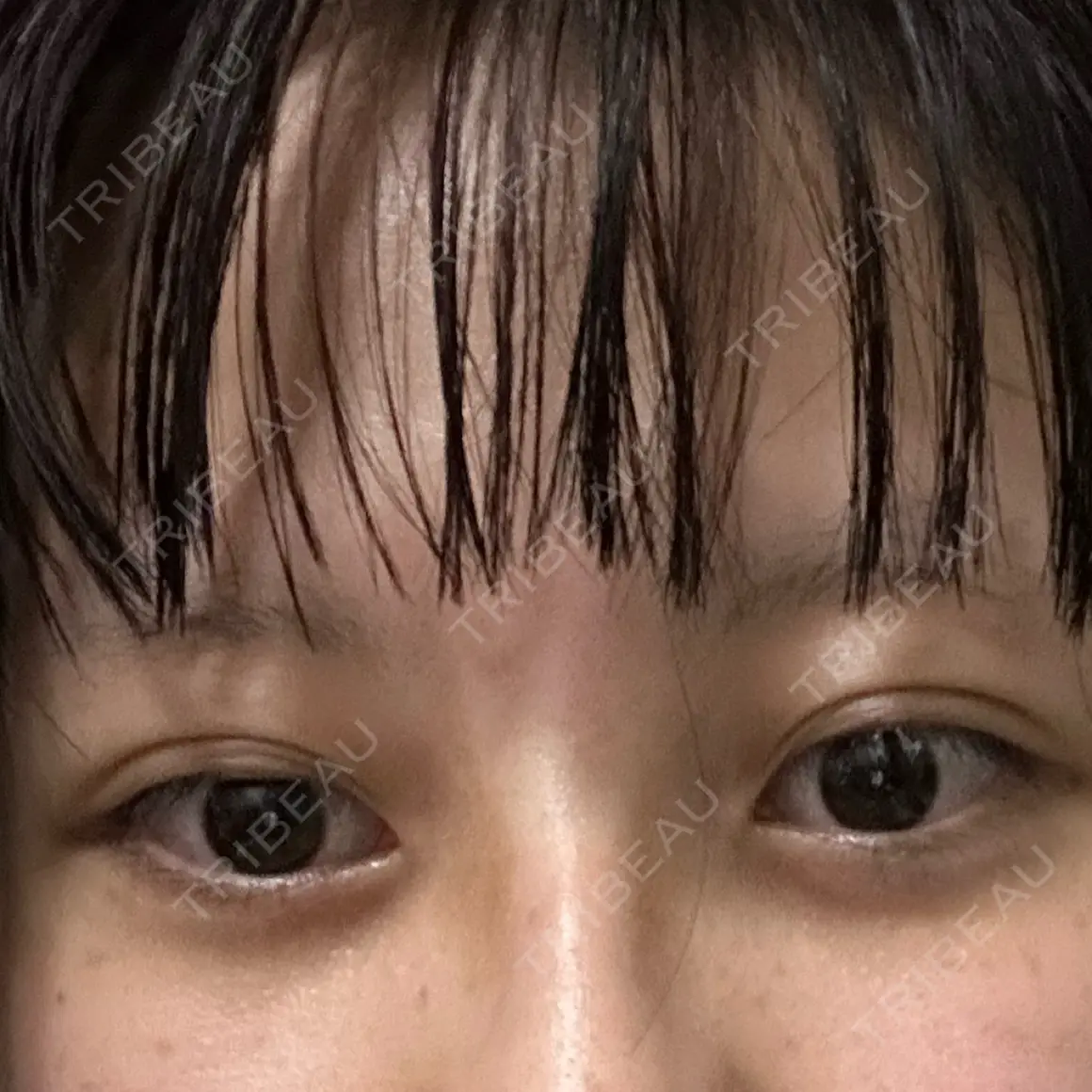 クマ治療 藤・ナチュレ美容クリニック 銀座院 AFTER