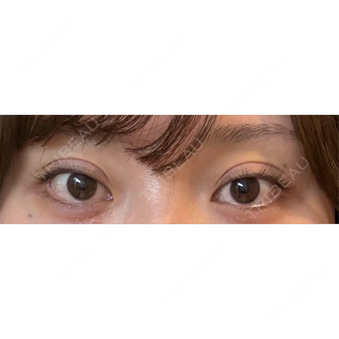 二重埋没 湘南美容クリニック 池袋東口院 DAY 0