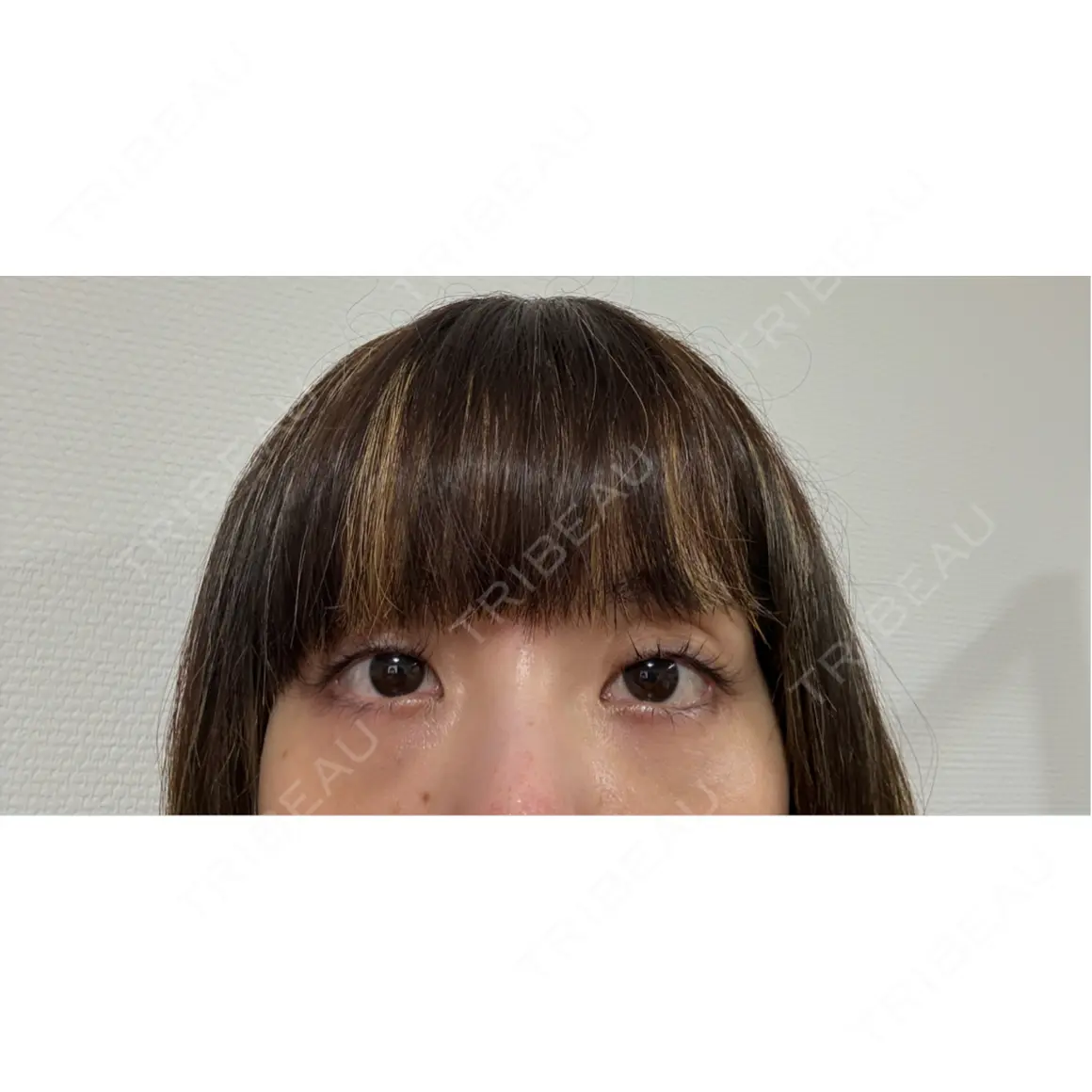 クマ治療 / 脂肪注入（肌） eクリニック 那覇院 AFTER