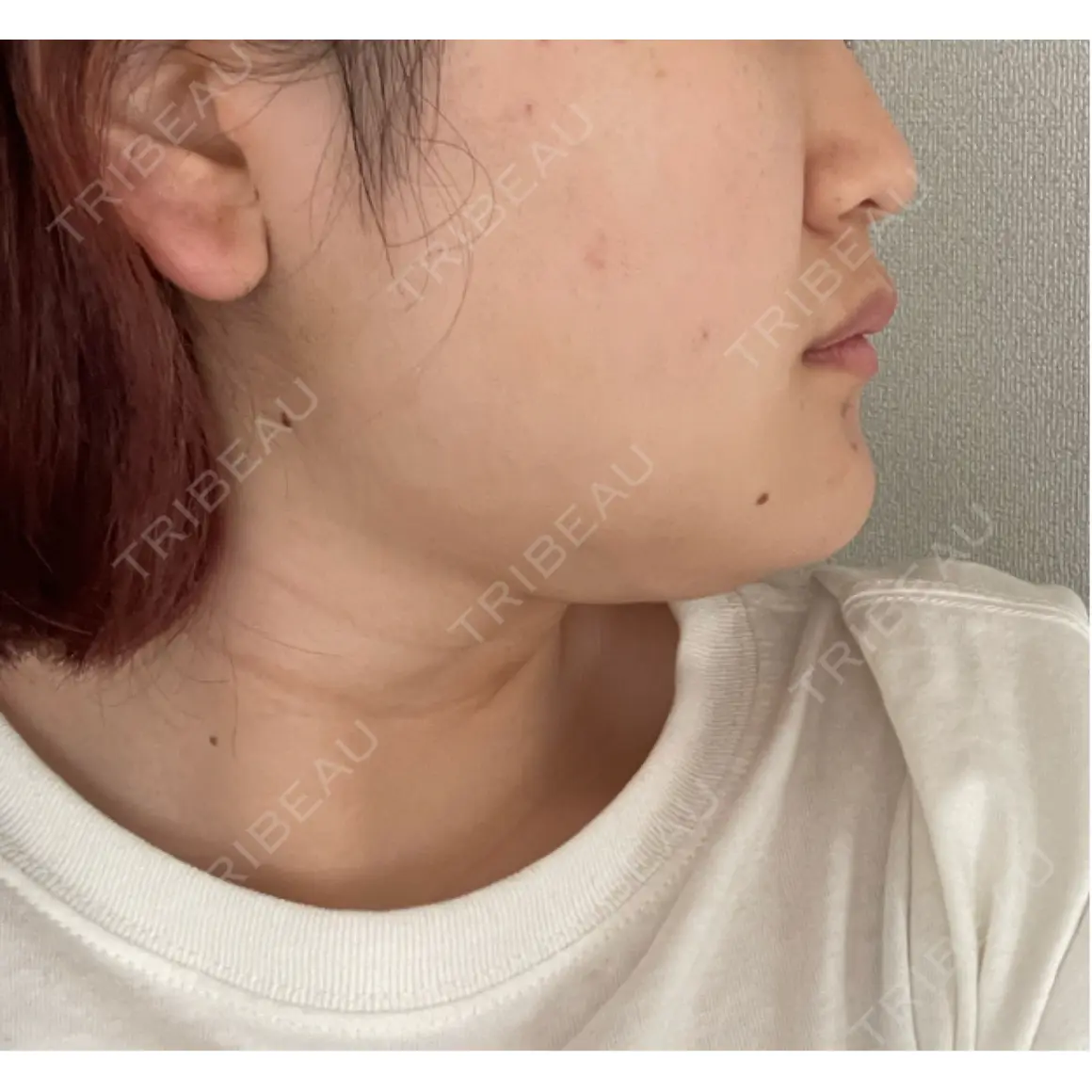 糸リフト / 脂肪吸引（顔） / ボトックス（あご） / その他（輪郭） ziz CLINIC AFTER