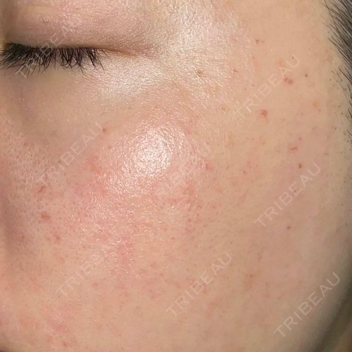 ピーリング（ハリ・ツヤ） / ルメッカ PureMe Skin Clinic（ピュアミースキンクリニック麻布） DAY 0