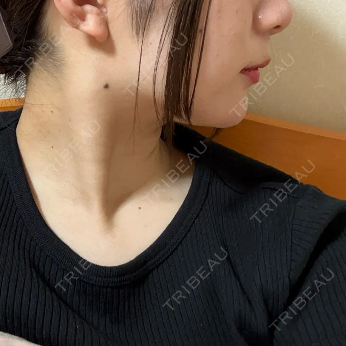 ボトックス（あご） / ヒアルロン酸注入（あご） 銀座みゆき通り美容外科 大阪梅田院 AFTER