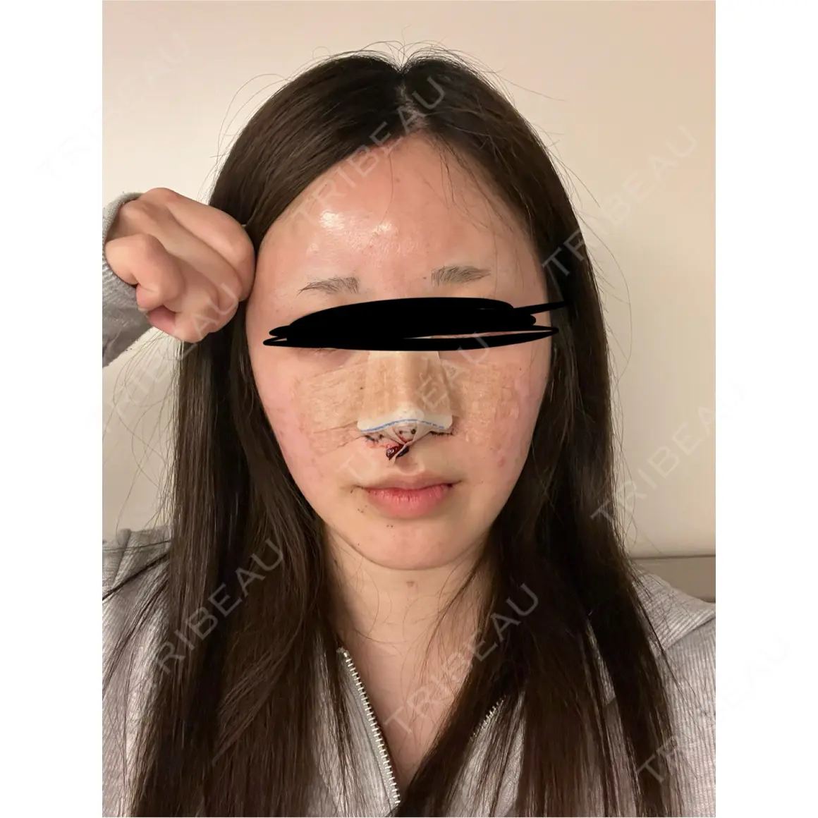 鼻尖形成（切開） / 小鼻縮小（切開） / 軟骨移植 / ワシ鼻修正・ハンプ切除 グローバルビューティークリニック 大阪院 DAY 0