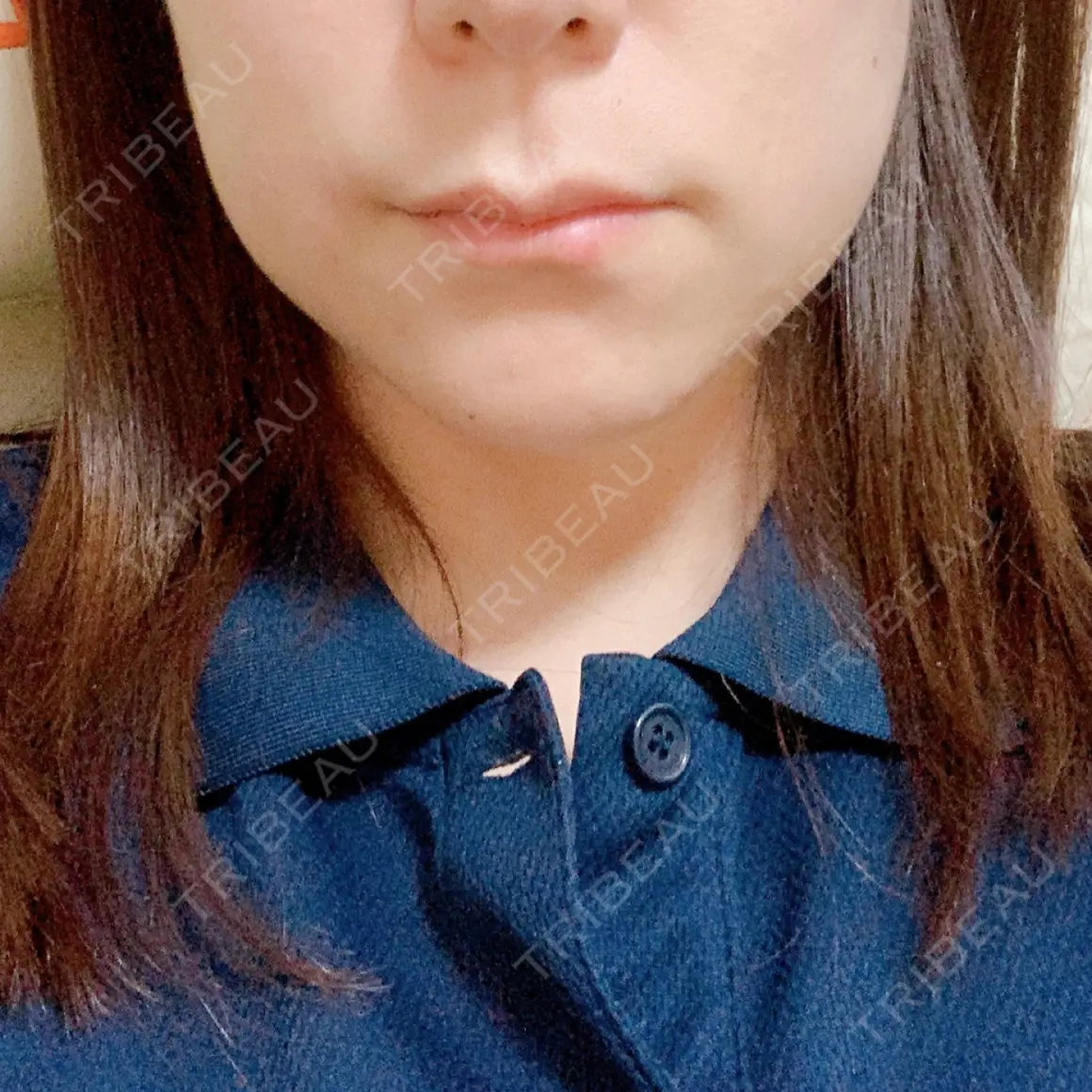 ハイフ（顔） しんゆり美容健康クリニック DAY 0
