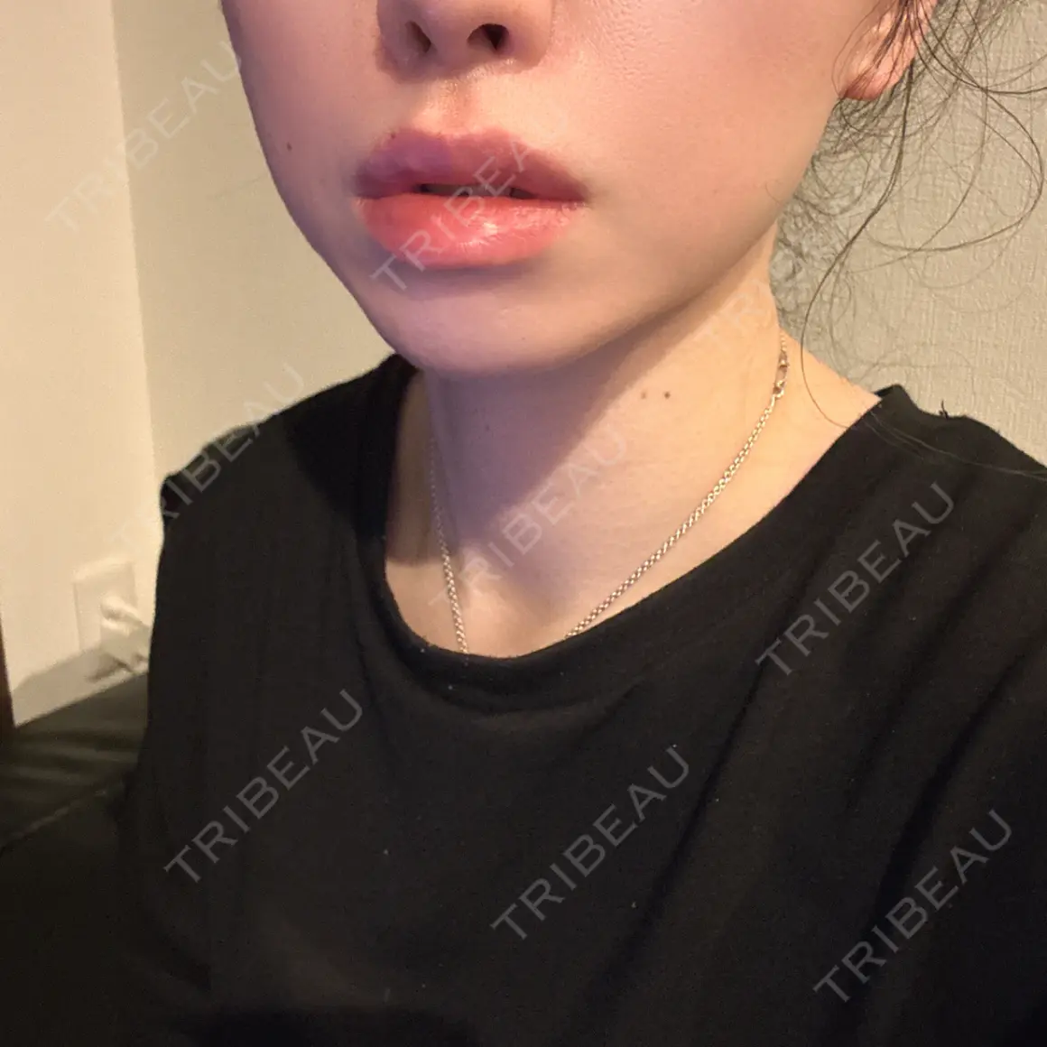 ヒアルロン酸注入（唇） PRO CLINIC プロクリニック 銀座院 AFTER