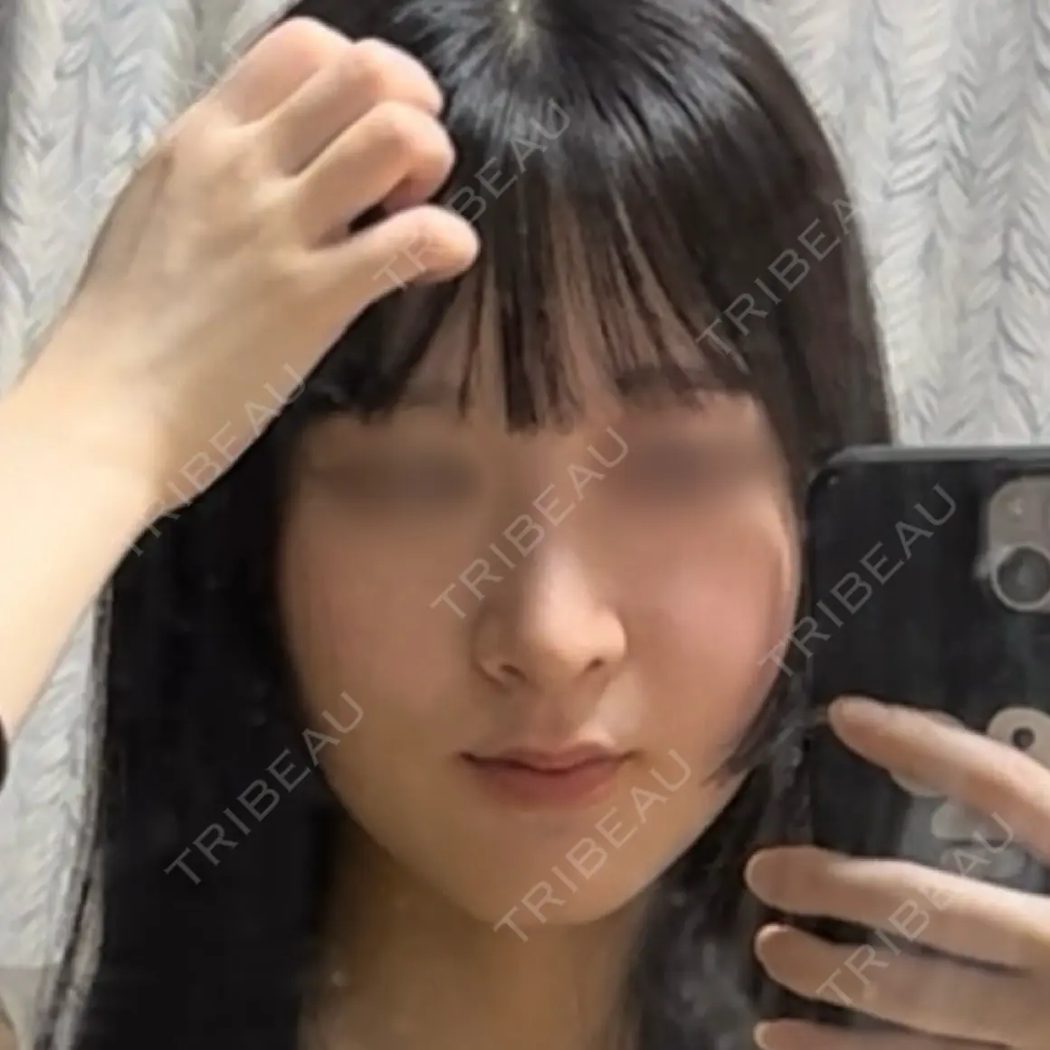 鼻尖形成（切開） / 軟骨移植 / 鼻柱下降・鼻唇角形成（猫手術） 東京美専クリニック AFTER