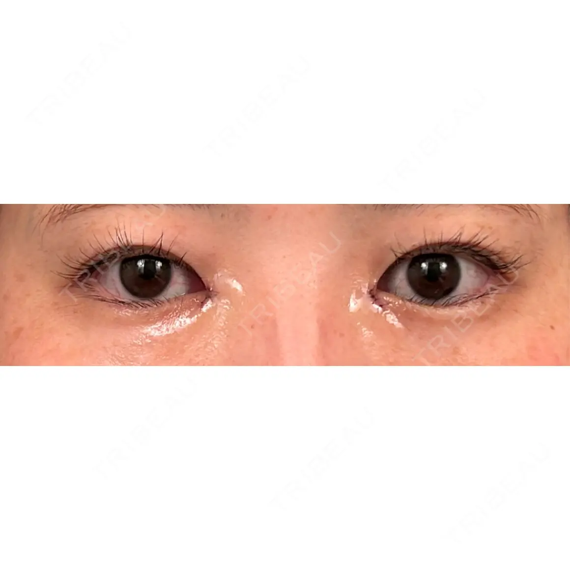 目頭切開 くさのたろうクリニック DAY 0
