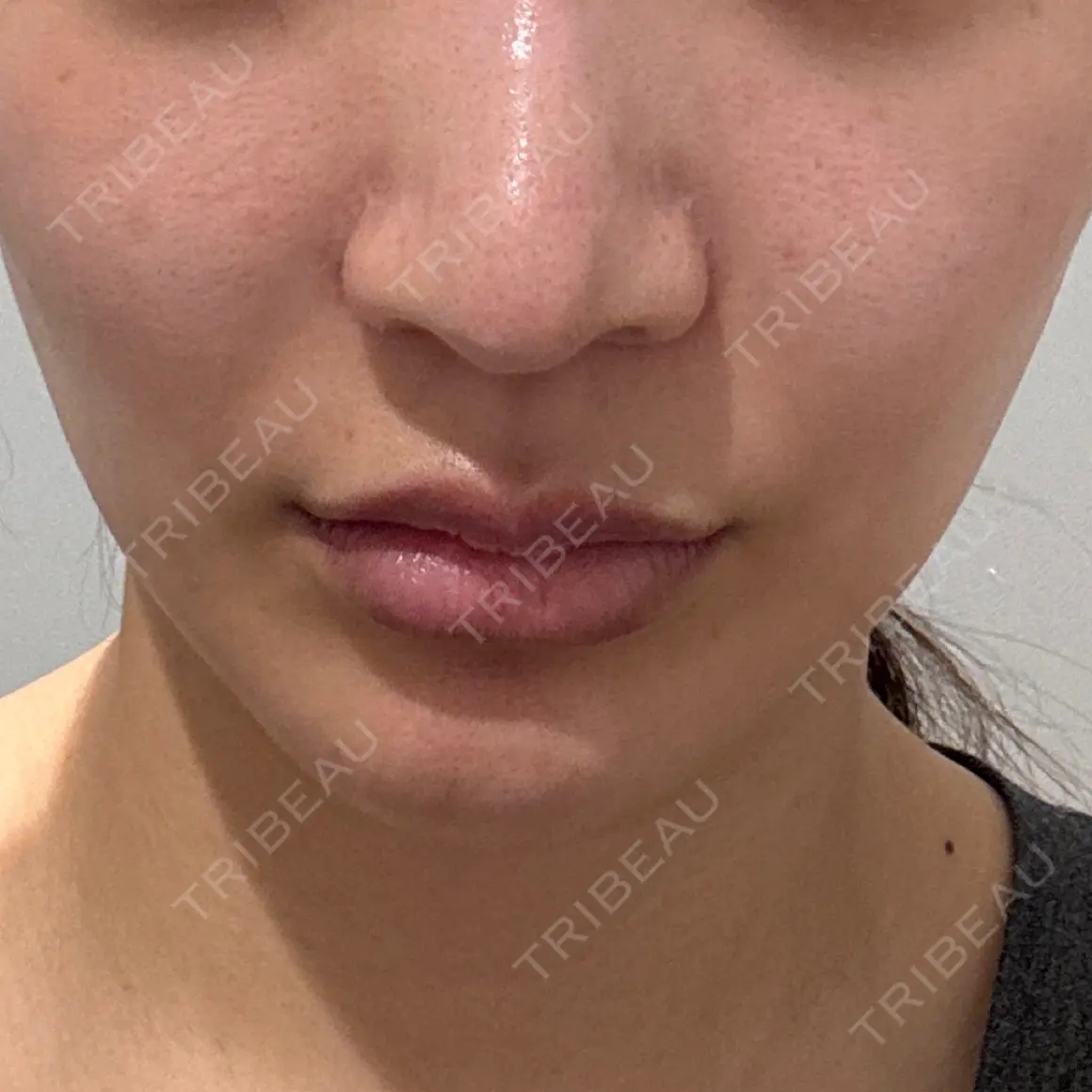 糸リフト 9BeautyClinic AFTER