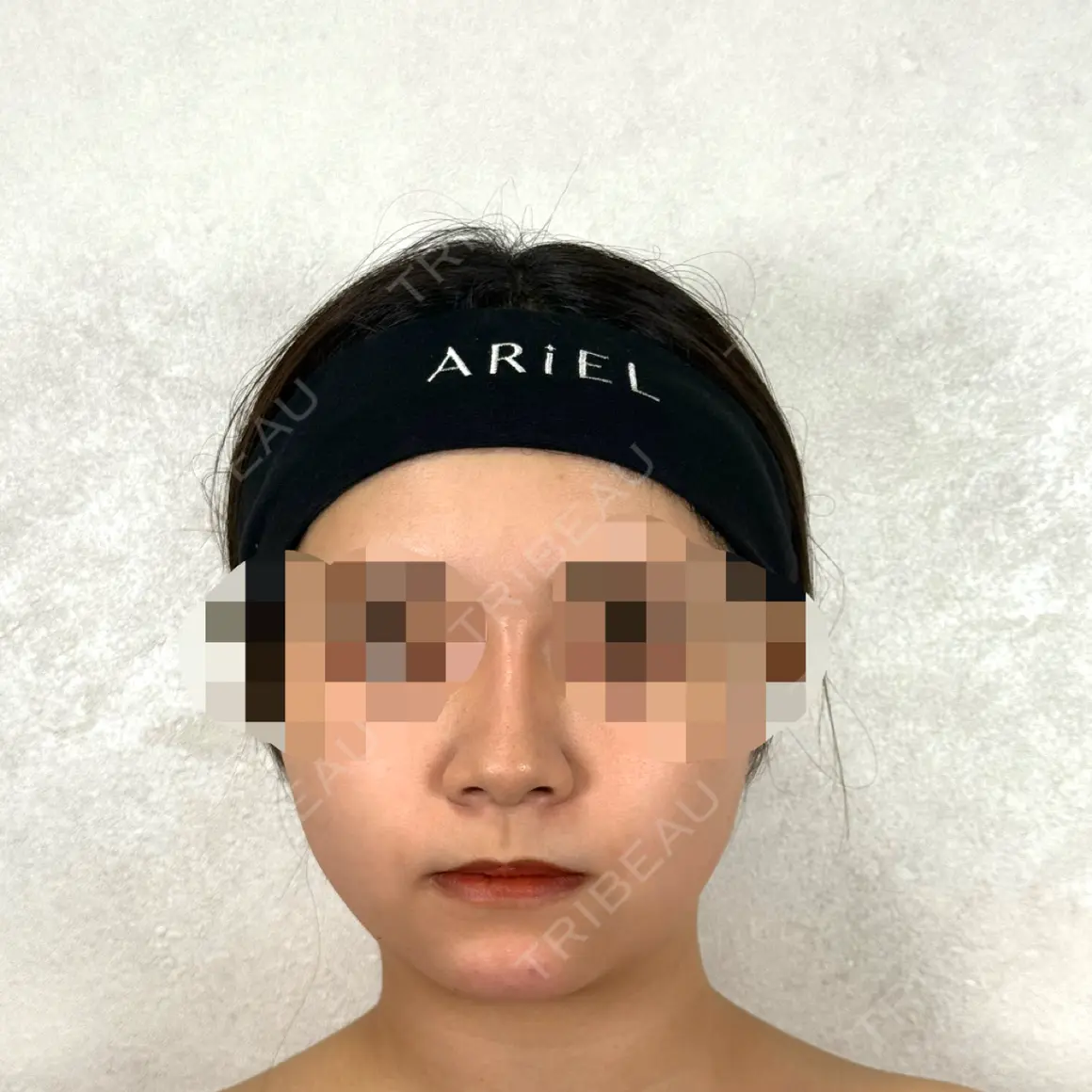ヒアルロン酸注入（鼻） / ヒアルロン酸注入（あご） アリエル美容クリニック 横浜院 DAY 0