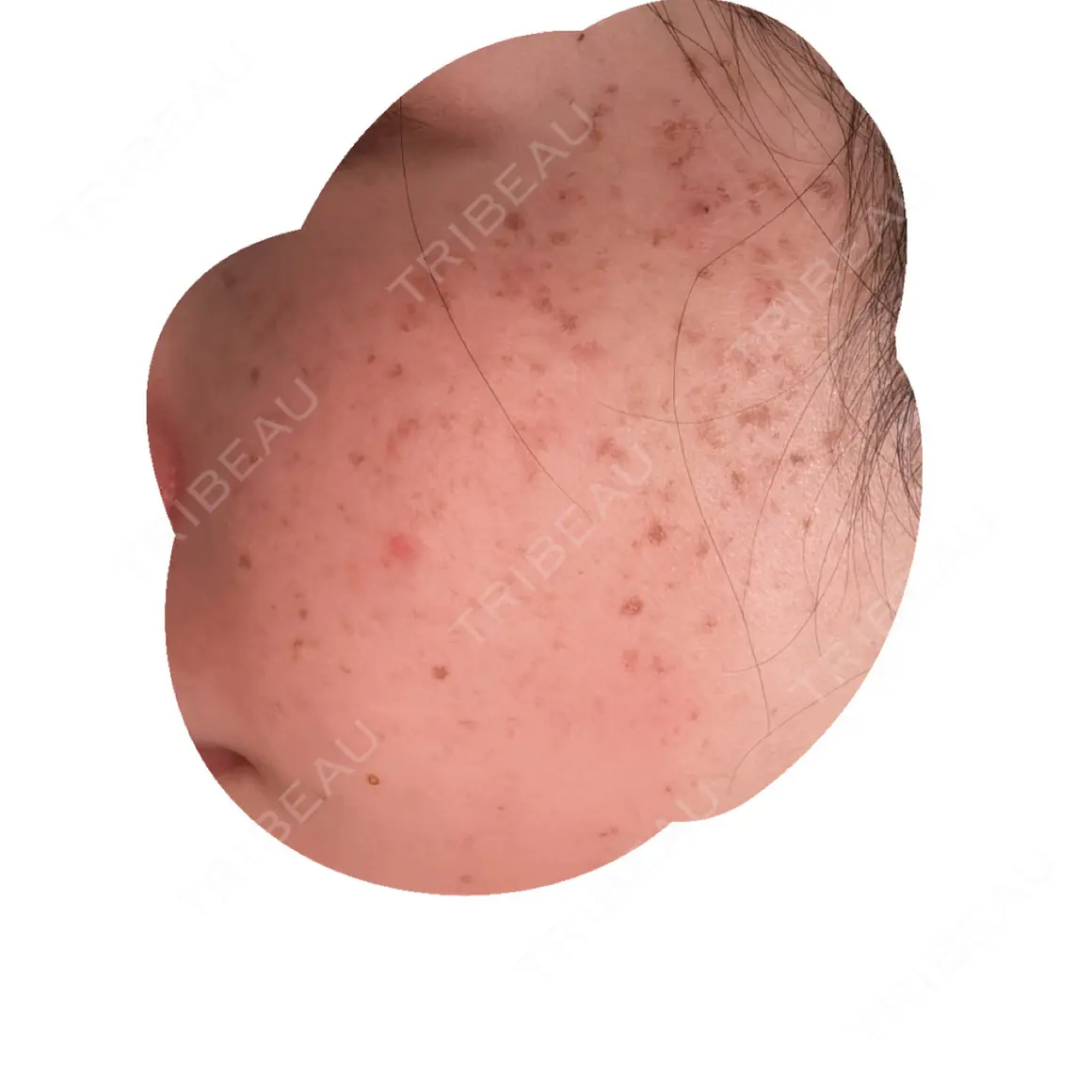 ピーリング（ハリ・ツヤ） / ルメッカ PureMe Skin Clinic（ピュアミースキンクリニック麻布） DAY 1