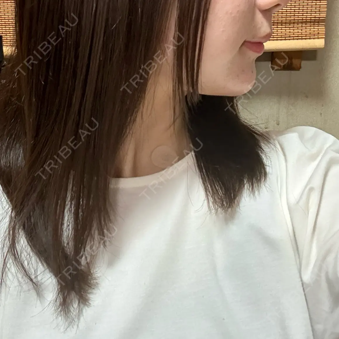 ボトックス（あご） / ヒアルロン酸注入（あご） 銀座みゆき通り美容外科 大阪梅田院 AFTER