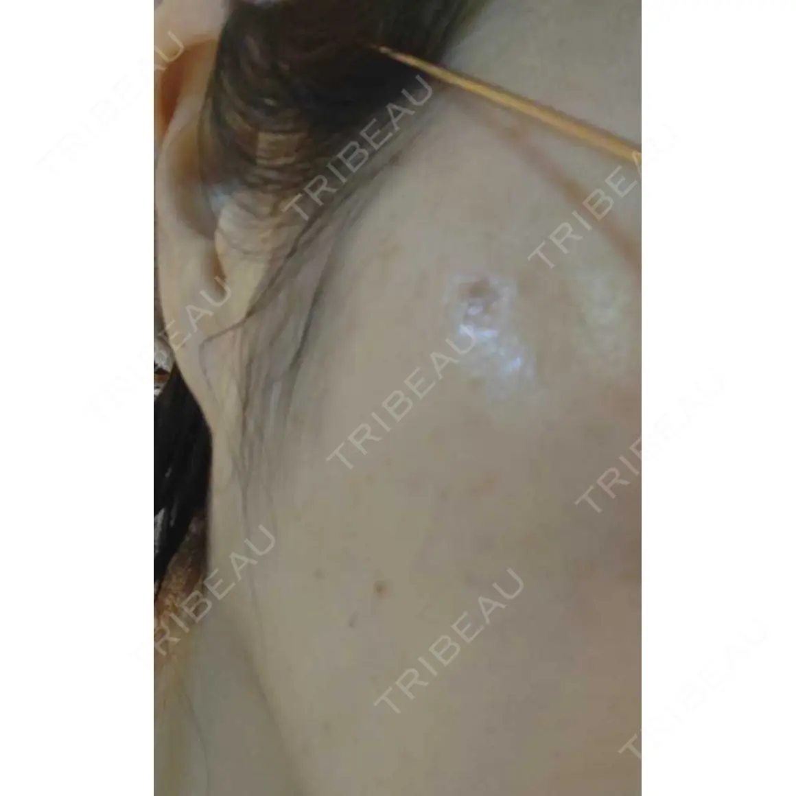 ピコスポット LIF SKIN CLINIC DAY 1