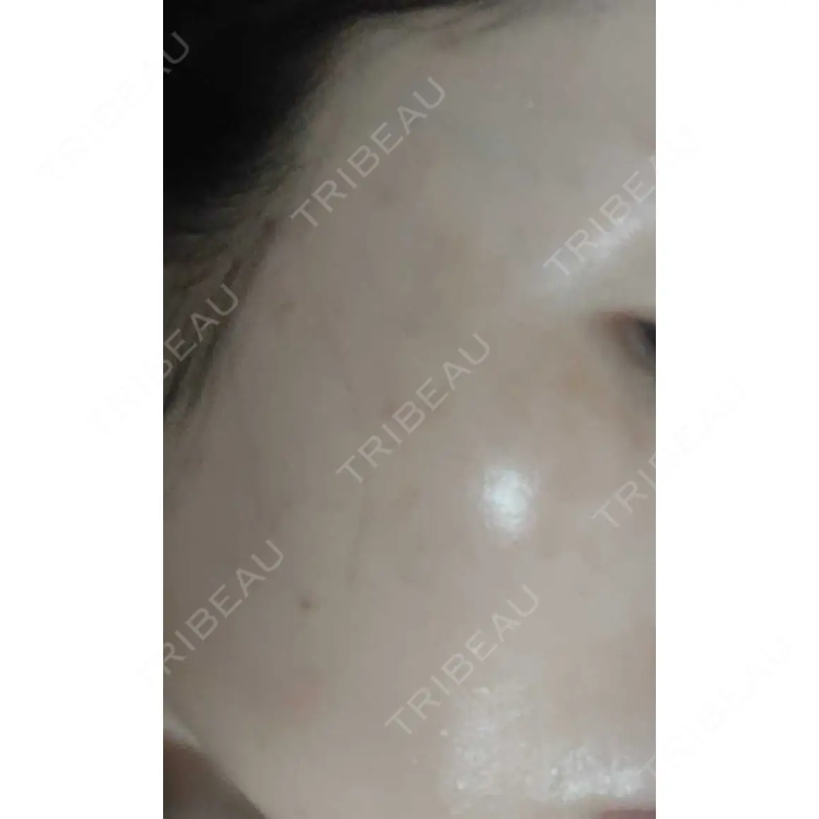 ピコスポット LIF SKIN CLINIC AFTER