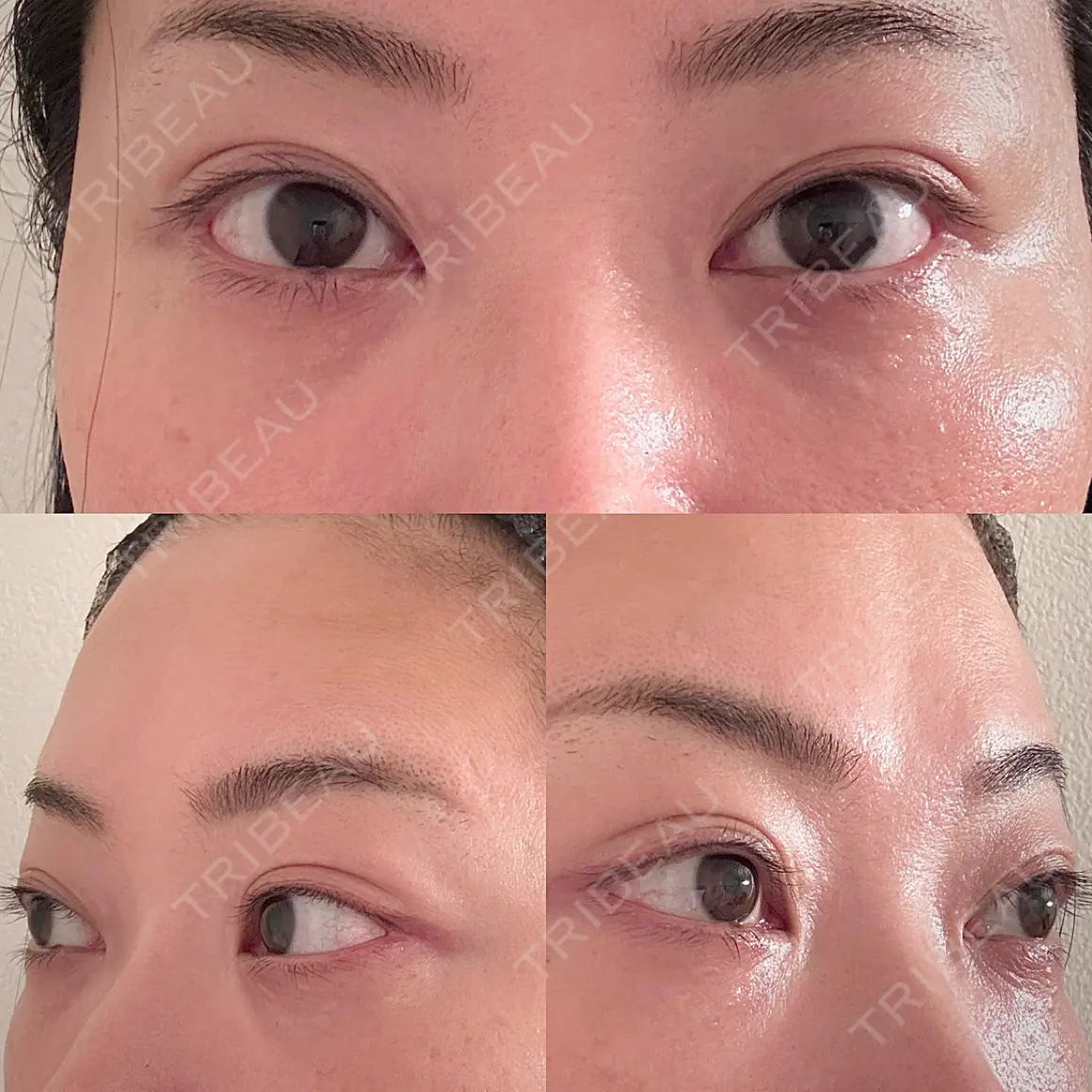 クマ治療 EMMO FACE CLINIC 東京三田院 AFTER