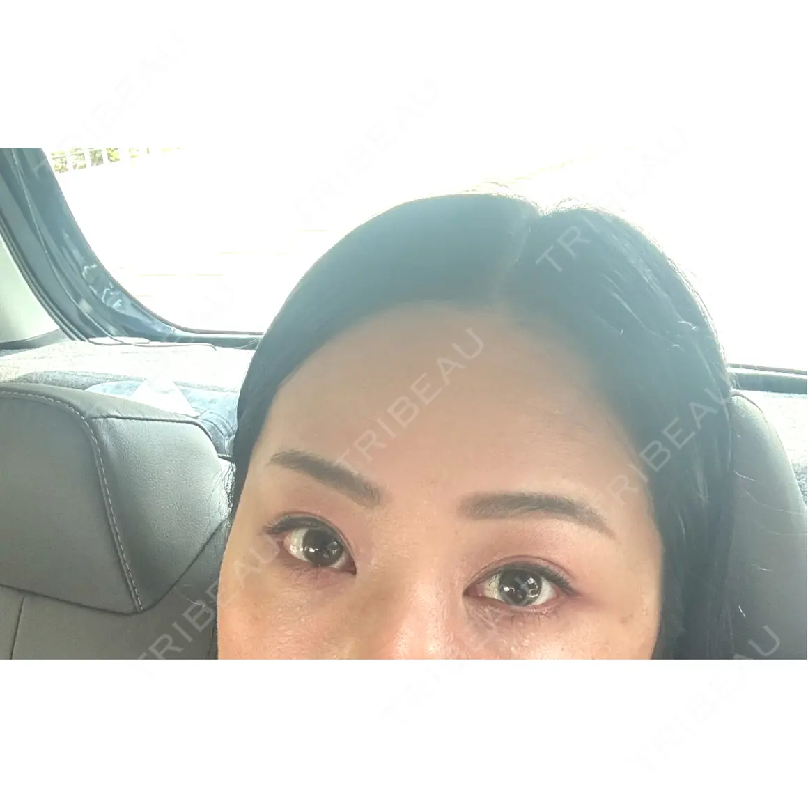 クマ治療 EMMO FACE CLINIC 東京三田院 AFTER